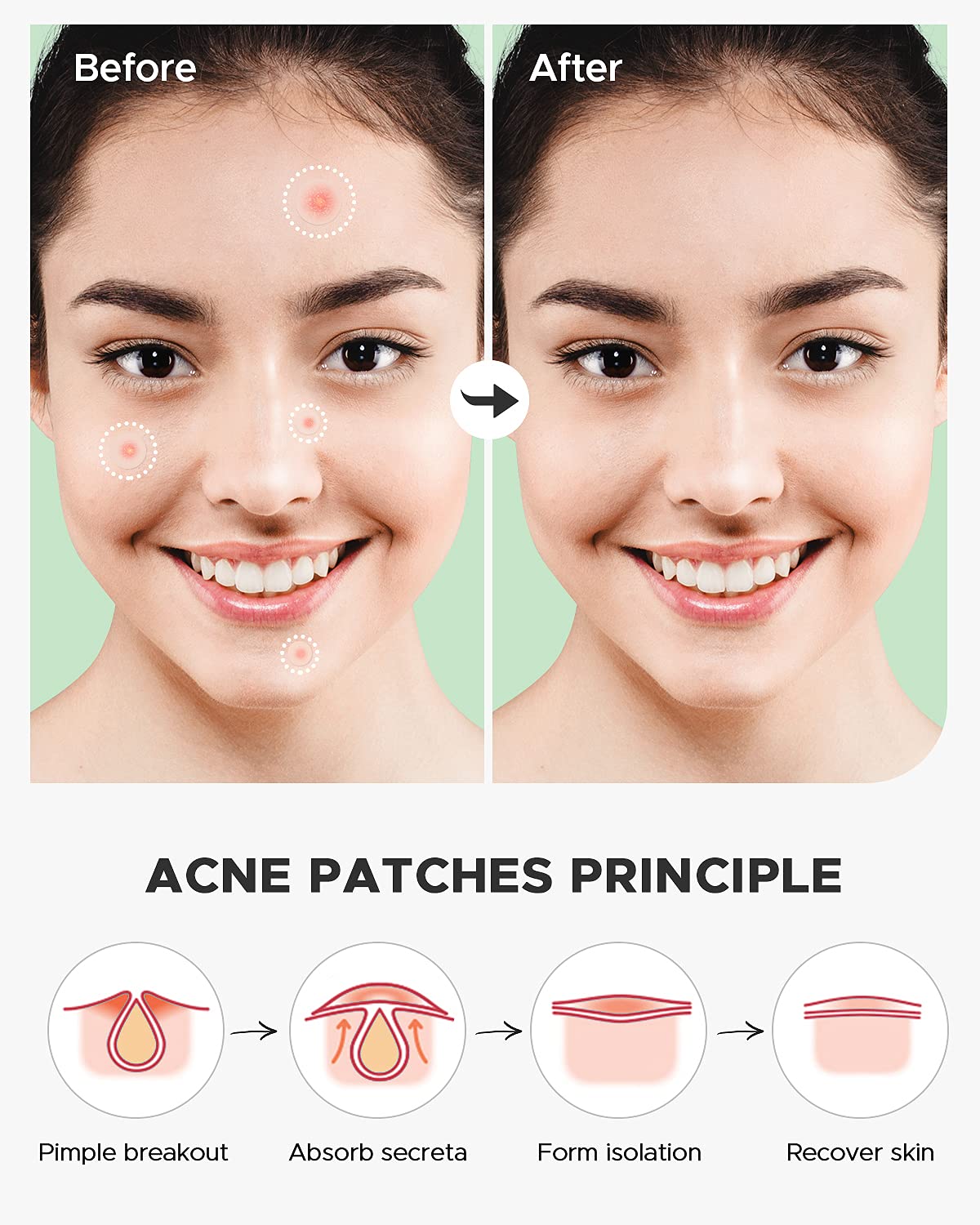 Acne Pimple Patch FSA Eligible Invisible Hydrocolloid Acne - ZATKTK Official Imagery - 7