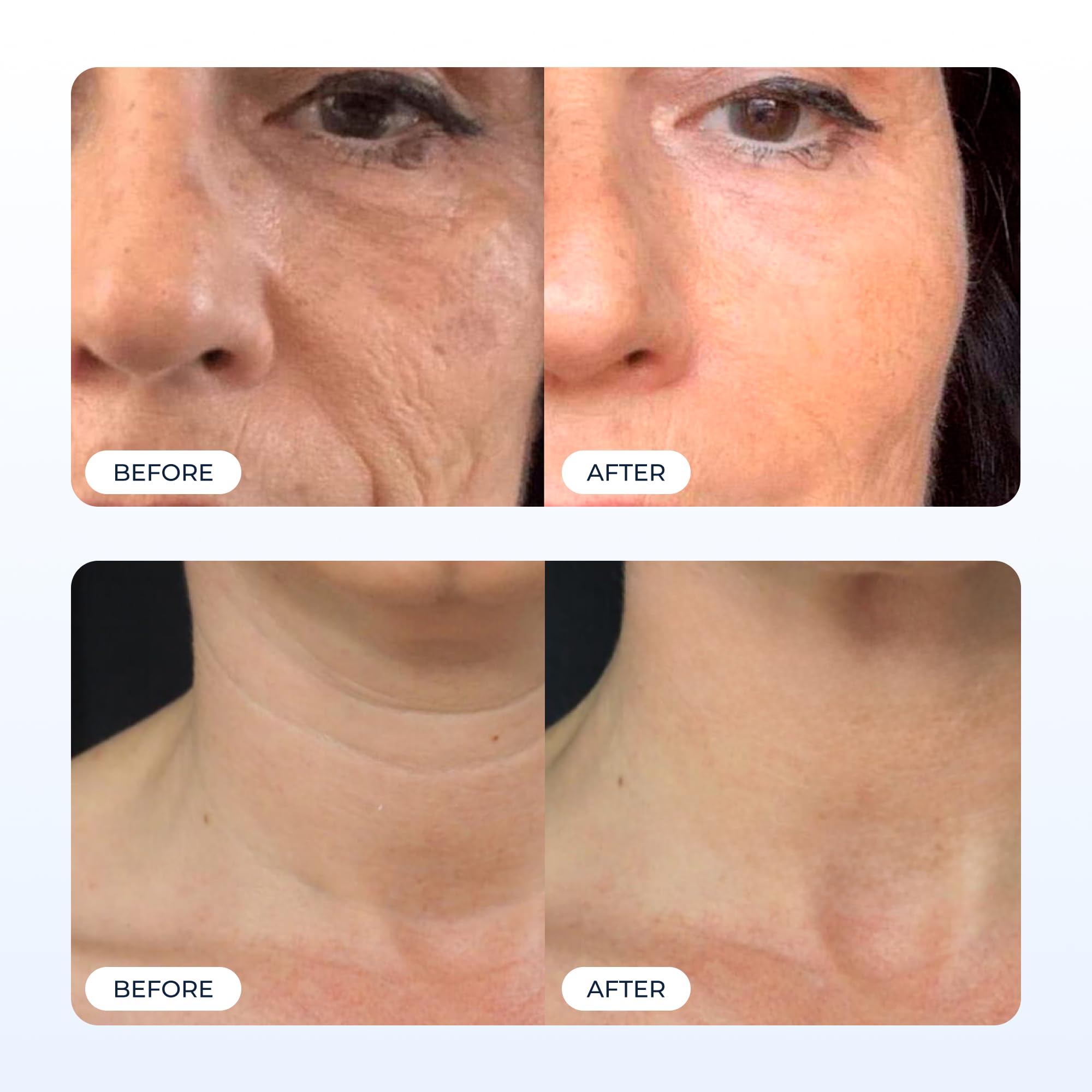 Original Glamory Radiant Flawless Skin Micro Infusion Kit - Glamory Official Product Imagery - 5