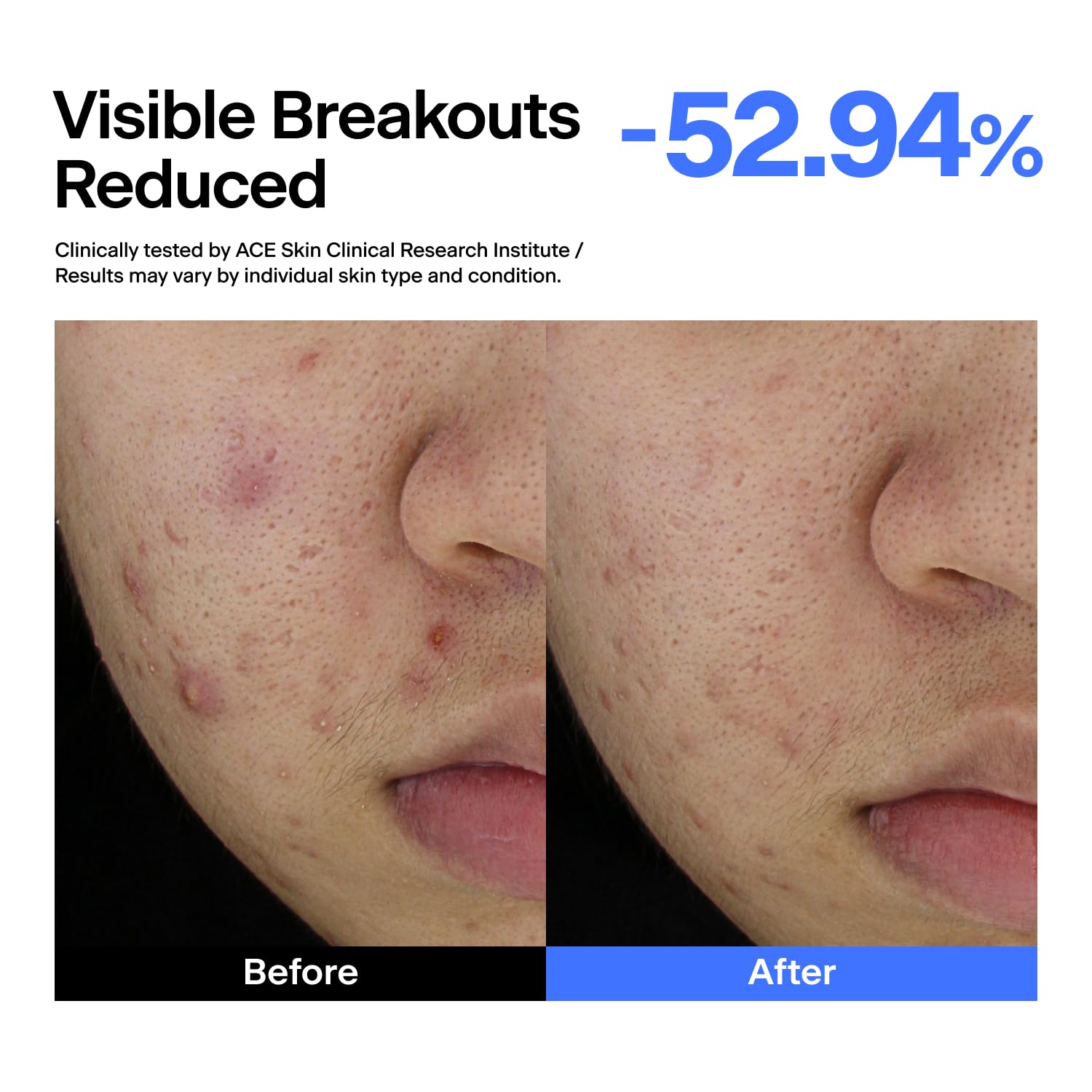 Azelaic Acid Niacinamide Centella Asiatica Serum for Dark - THOME Official Imagery - 7