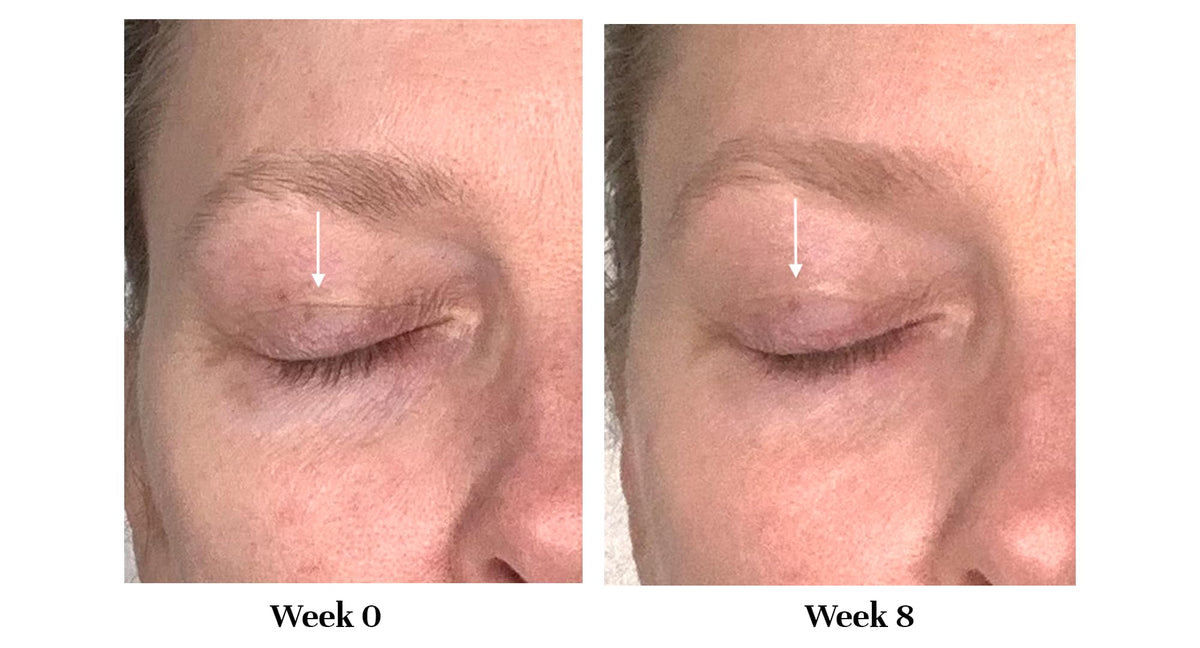 City Beauty Lid Lifting Treatment - City Beauty Official Imagery - 6