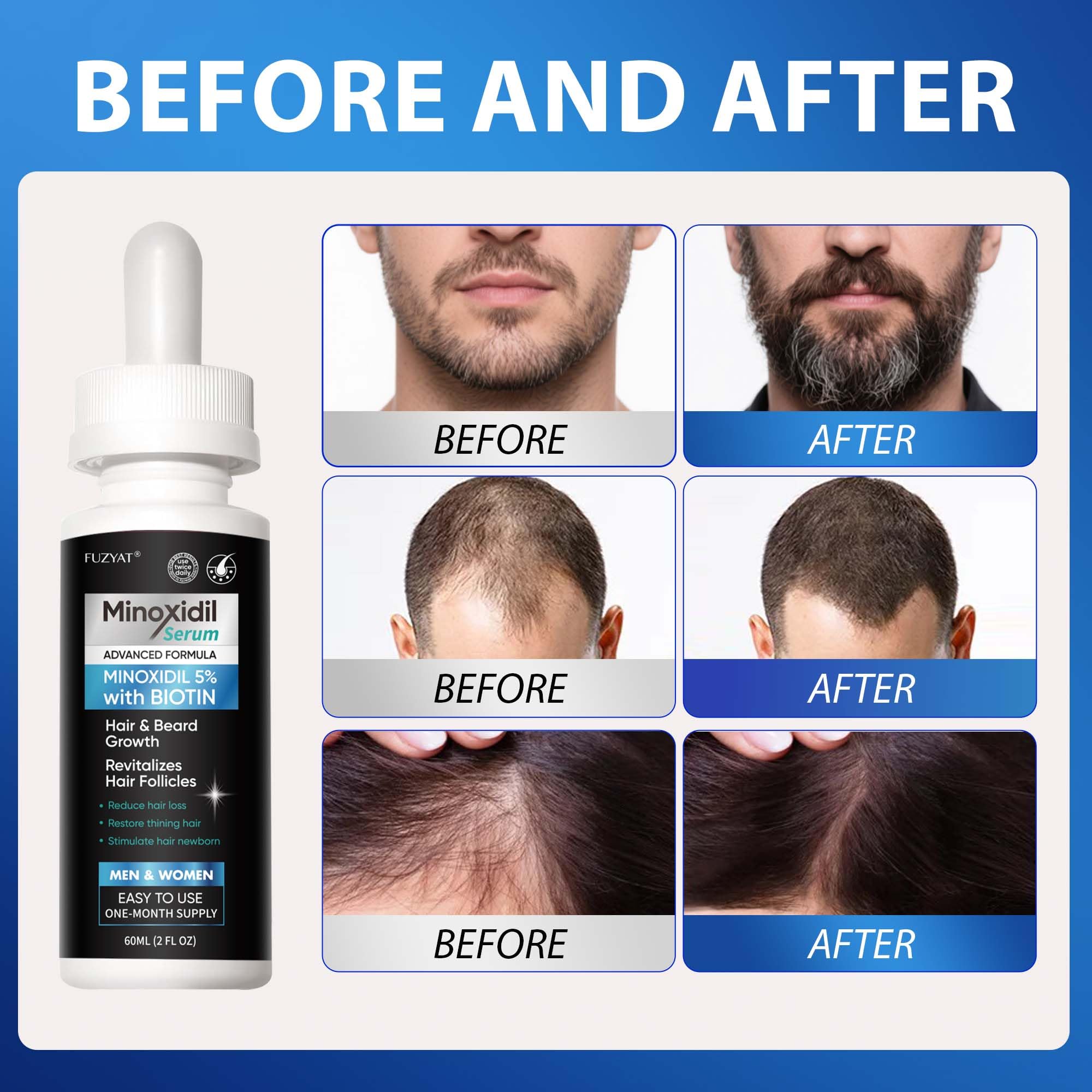 FUZYAT 5% Minoxidil , Minoxidil Hair Growth Treatment, Beard Growth Serum, - FUZYAT Official Product View 5