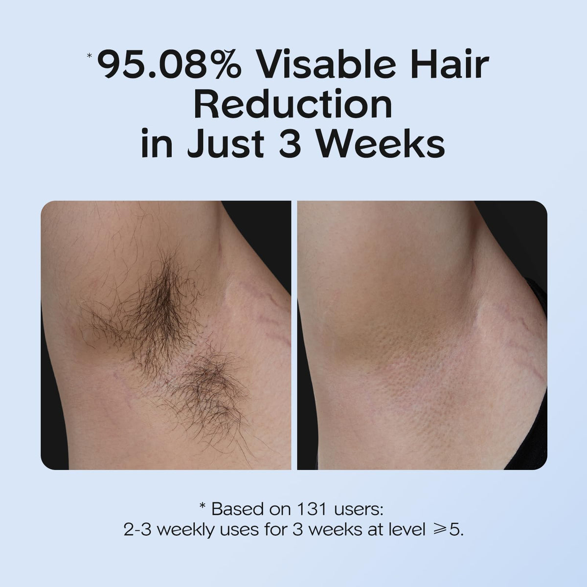 INNZA IPL Hair Removal with Ice Cooling Care Function for - INNZA Official Imagery - 4