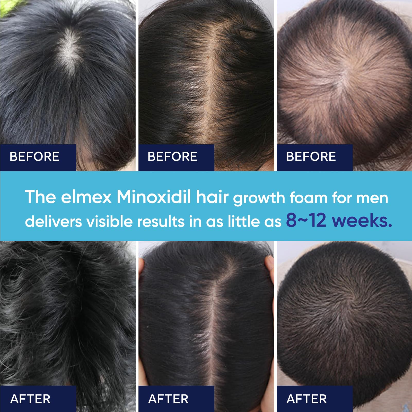 Artimore 5% Minoxidil Foam and Women, Minoxidil Foam for Hair and Beard, - Artimore Official Product View 7