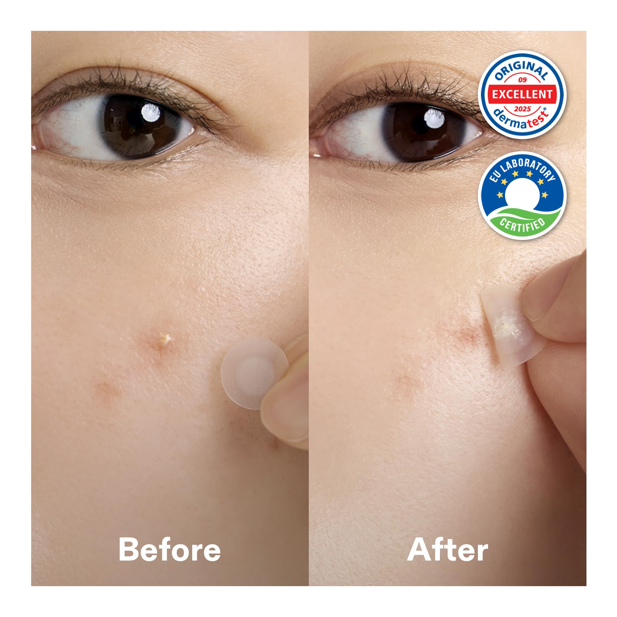 Cordiale Centella Pimple Patches with Salicylic &amp; Hyaluronic - CORDIALE