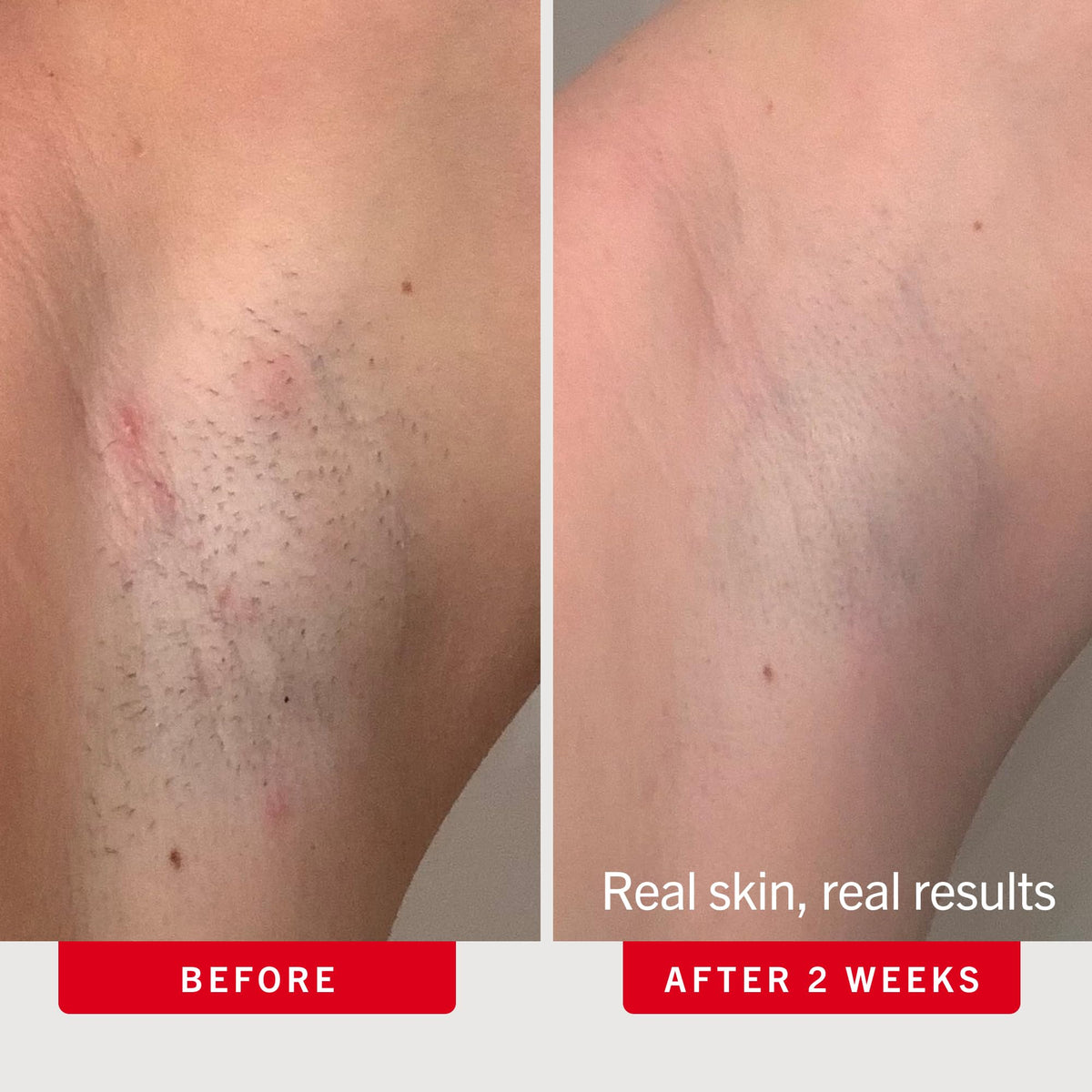 First Aid Beauty Ingrown Hair Pads with BHA and AHA - Premium Selection Official Imagery - 5