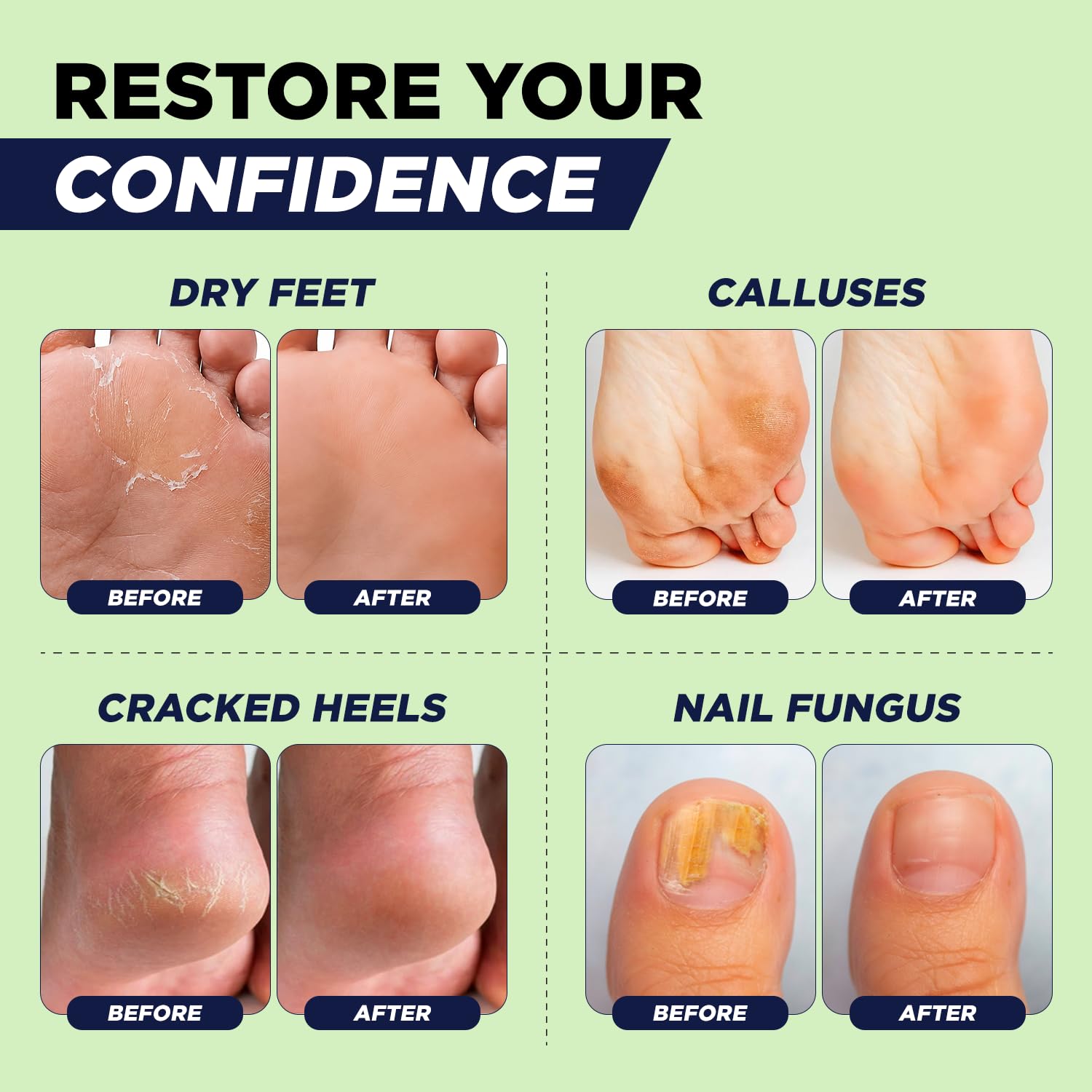 Tea Tree Oil Epsom Salt Foot Soak for Toenail Fungus Treatment, - FOOT CURE