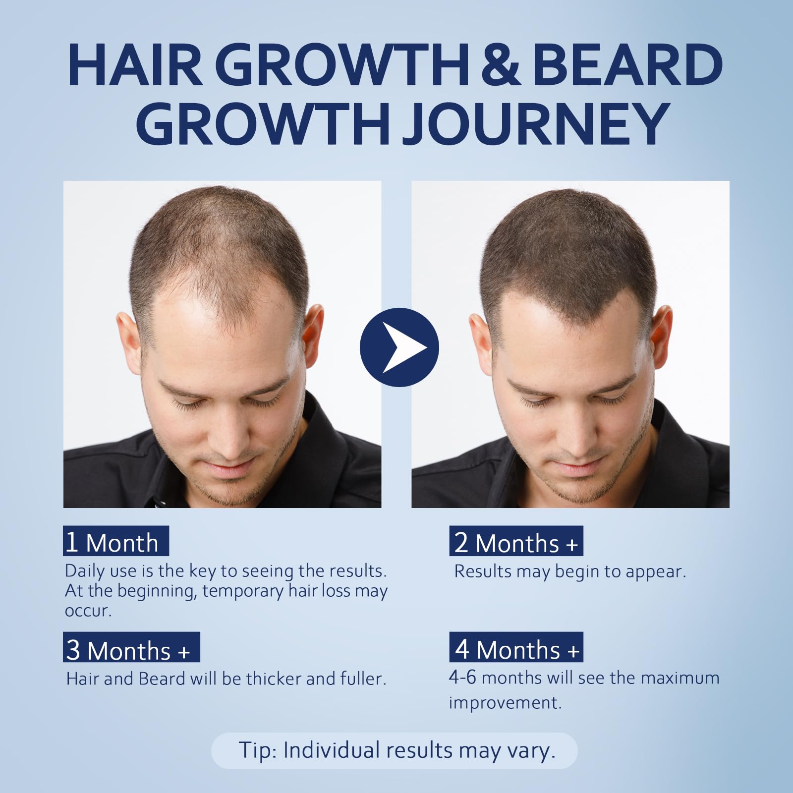 Artimore 5% Minoxidil Hair Growth Serum with Biotin - Minoxidil and Women & 5 - Artimore Official Product View 6