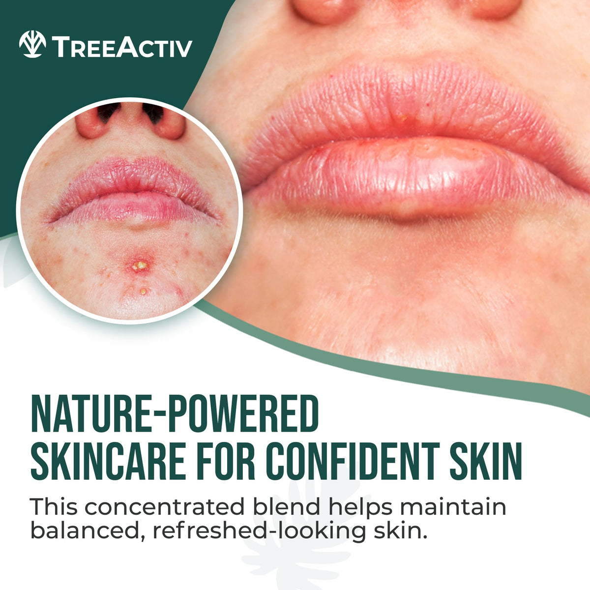 TreeActiv Cystic Acne Spot Treatment Hormonal Overnight - TreeActiv Official Imagery - 3