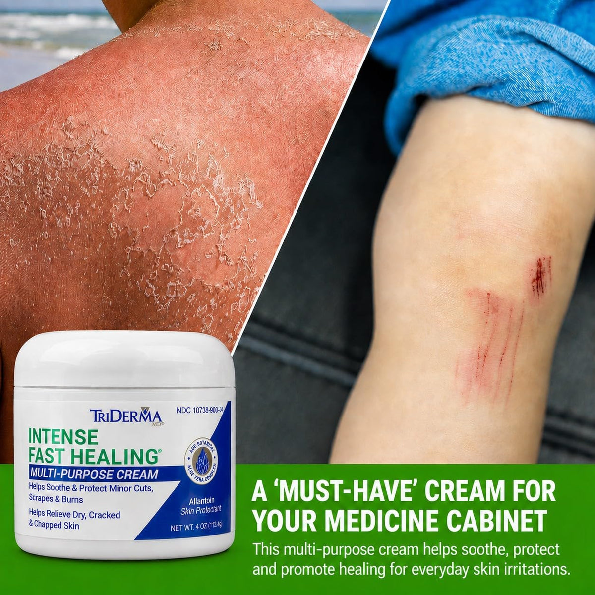 TriDerma Intense Fast Healing Cream Decreases Healing Time - TriDerma Official Imagery - 4