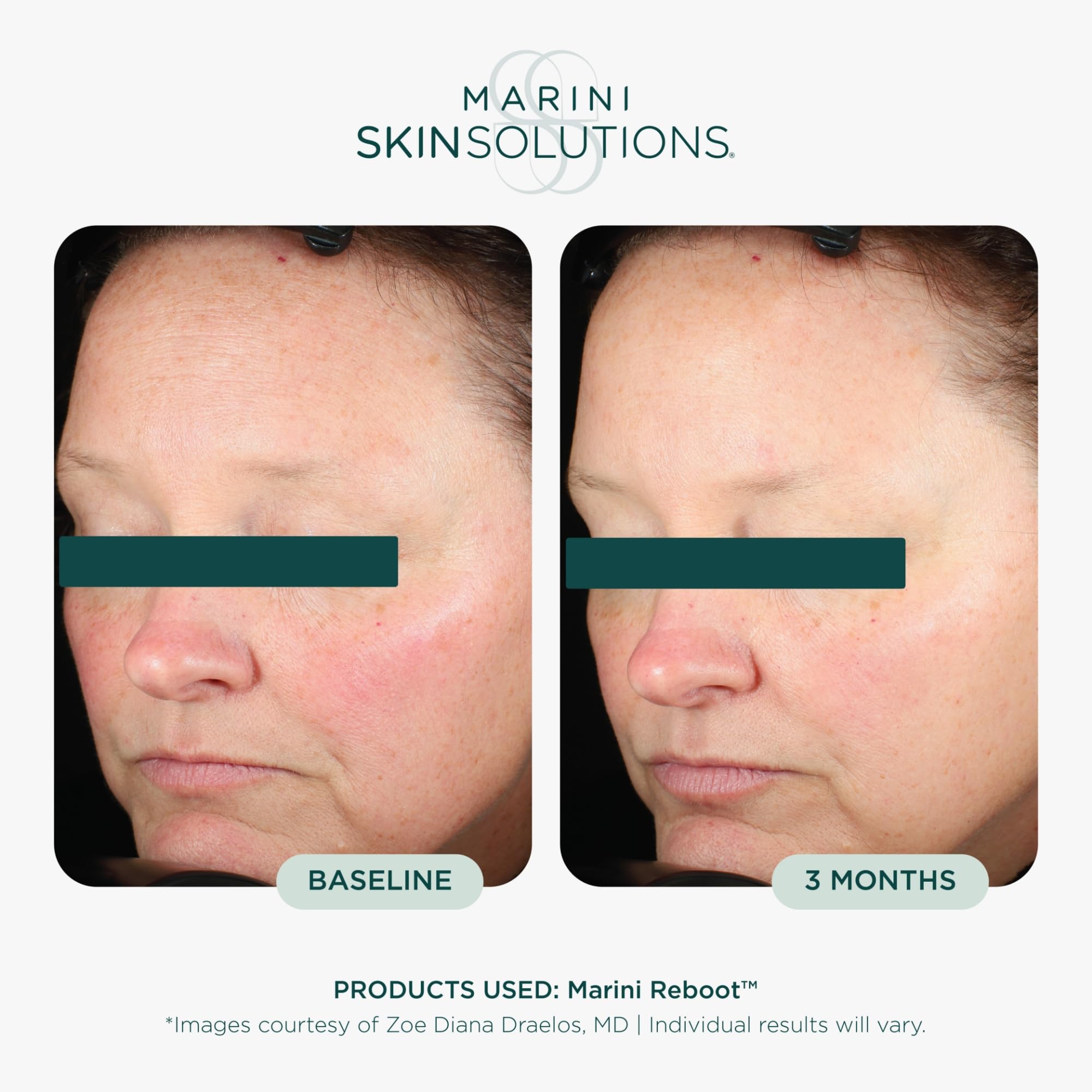 Marini SkinSolutions Marini Reboot - Anti Aging PDRN Face Serum Supports Vi - Marini SkinSolutions Official Product View 4
