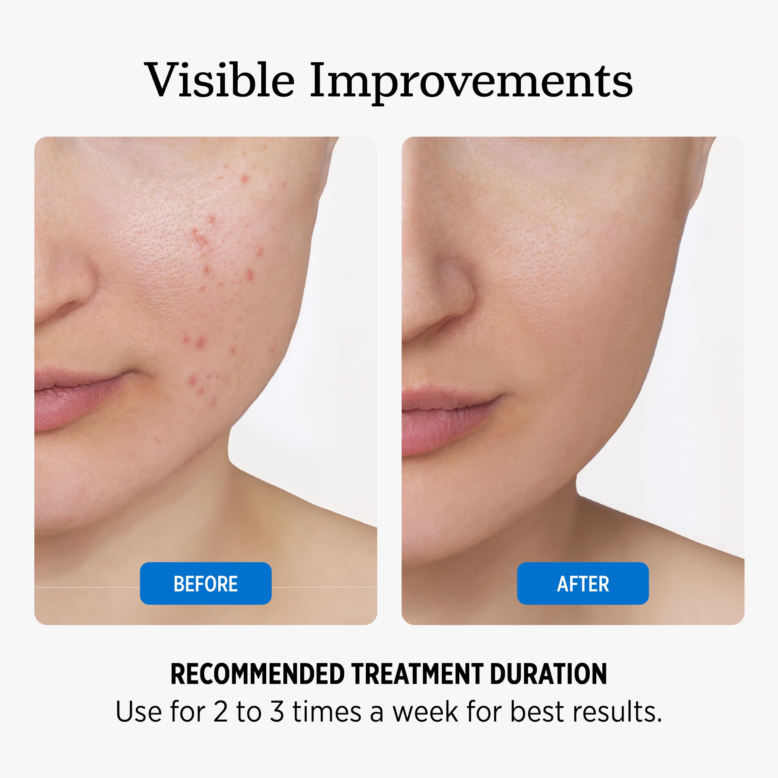 NUVADERMIS 35 Glycolic Acid Peel Pads Exfoliating Facial - NUVADERMIS Official Imagery - 7