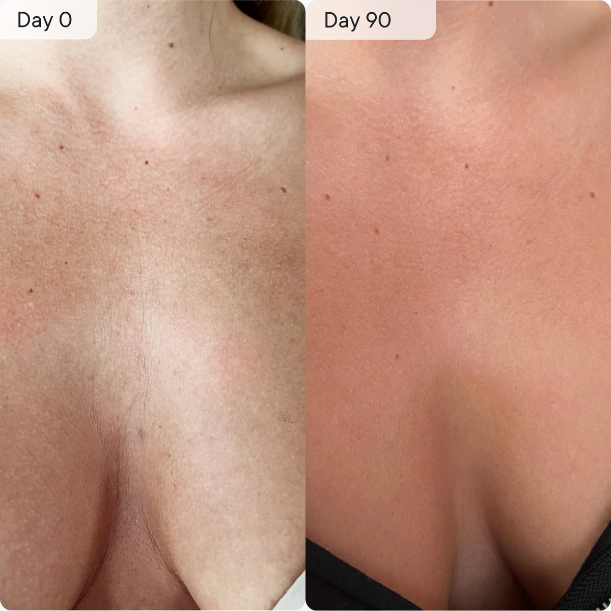 Qure Neck D colletage Chest LED System Red Light Therapy 2 - Qure Official Imagery - 8