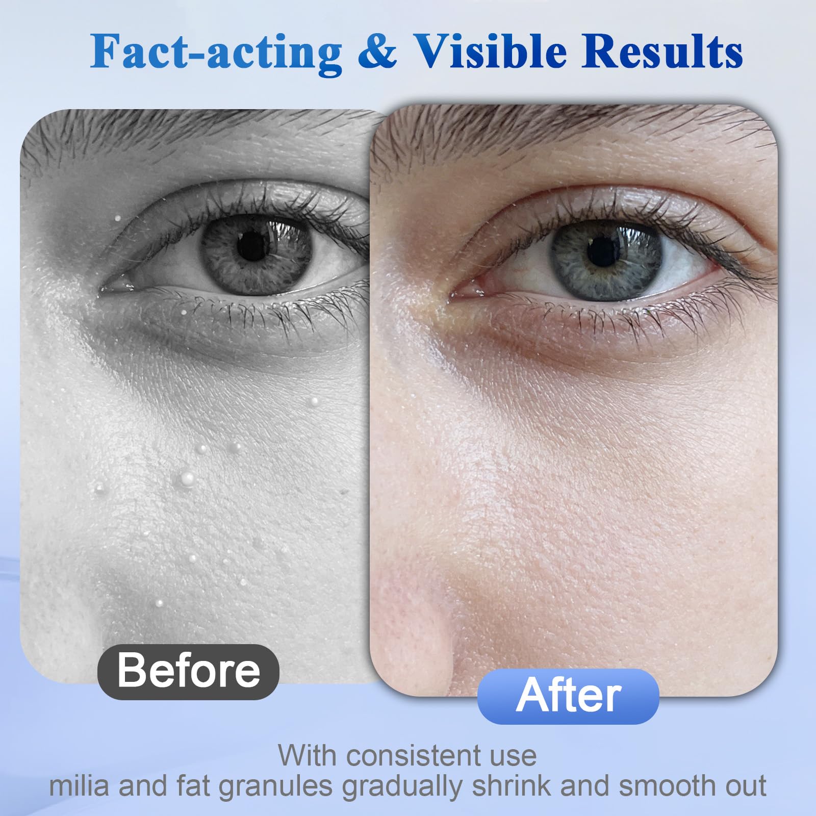 Milia Remover Serum 1% Salicylic Acid Face & Eyelids