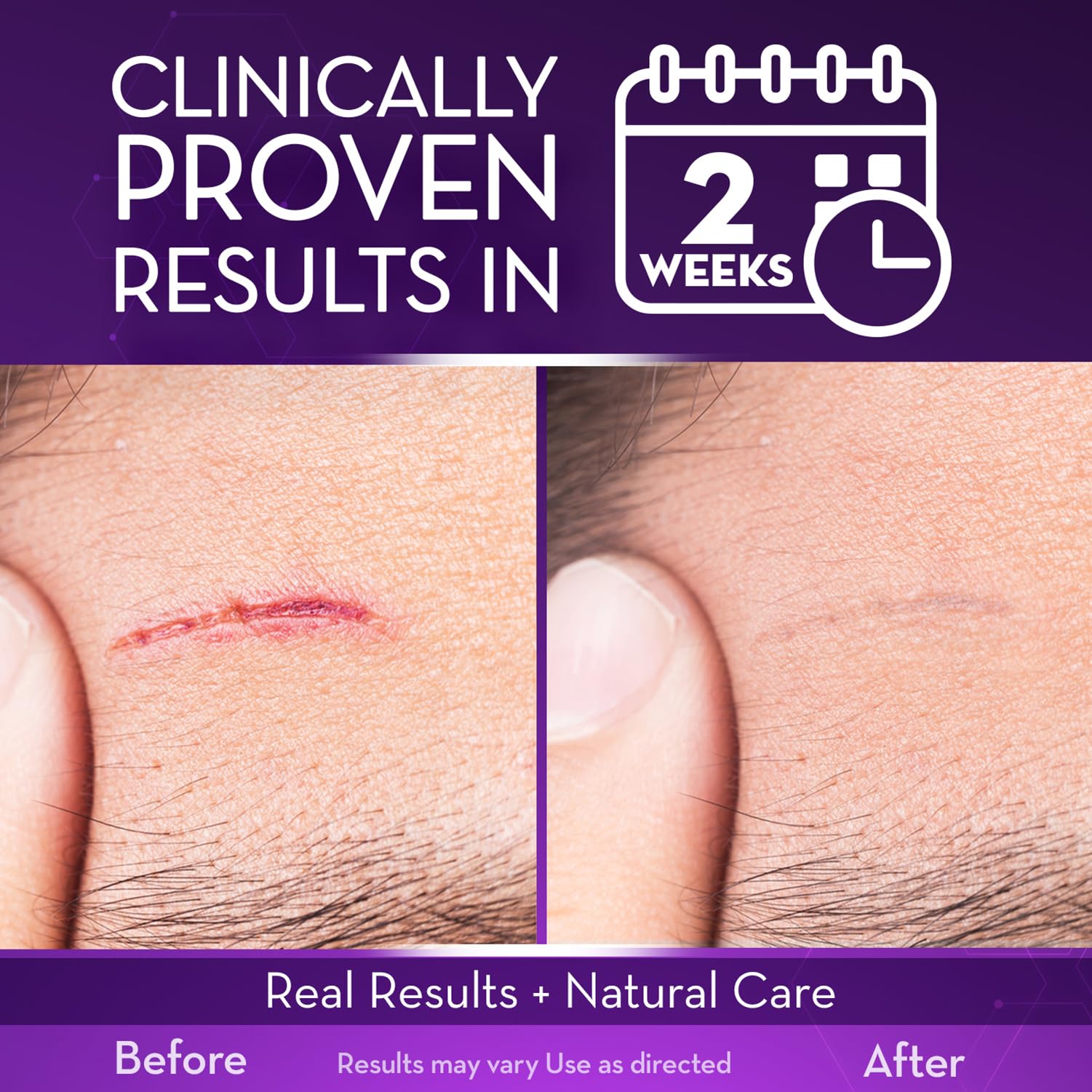 Cicatricure Advanced Scar Gel, Proven Results in 2 Weeks, 1 oz (28 g) - Cicatricure Official Product View 4