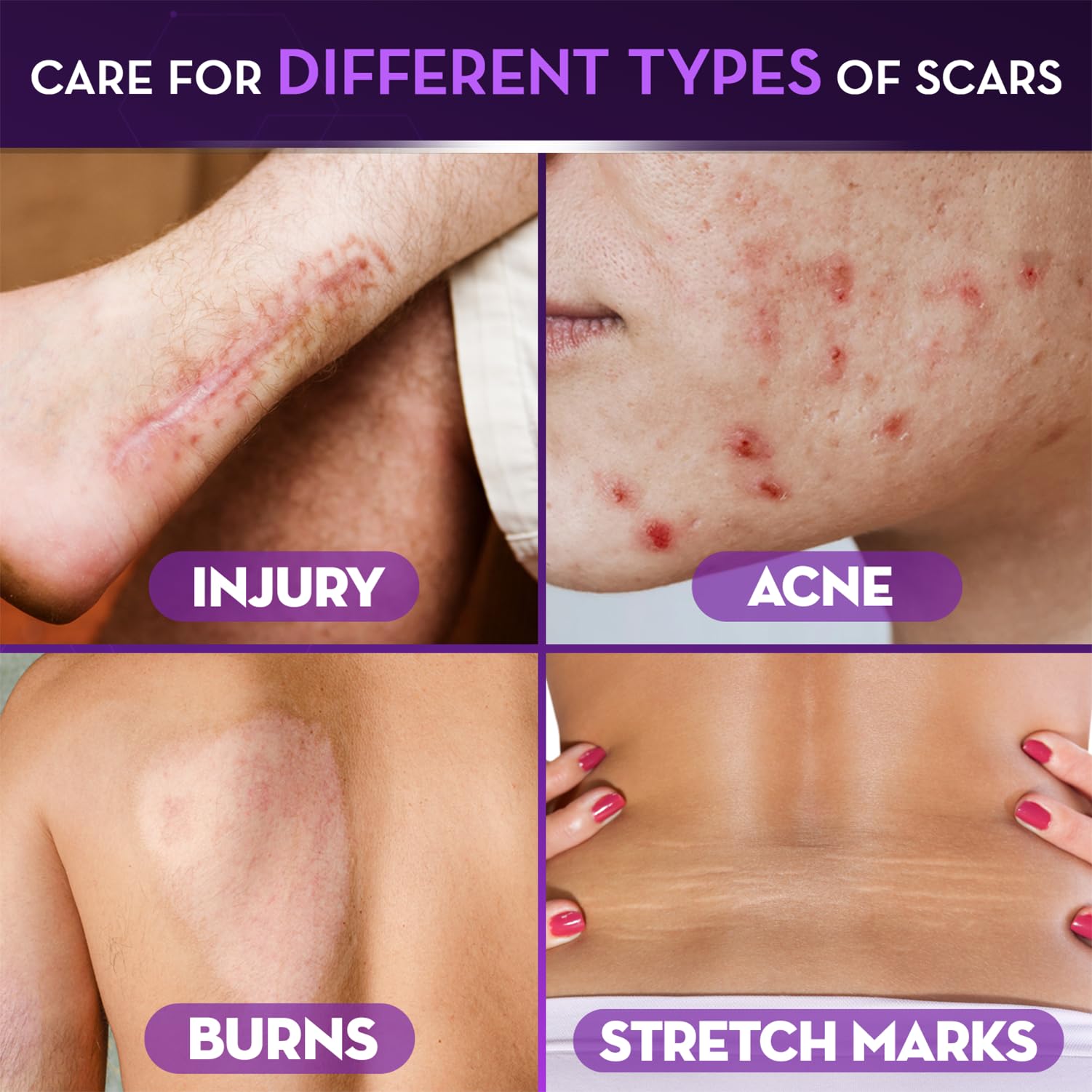 Cicatricure Advanced Scar Gel, Proven Results in 2 Weeks, 1 oz (28 g) - Cicatricure Official Product View 5
