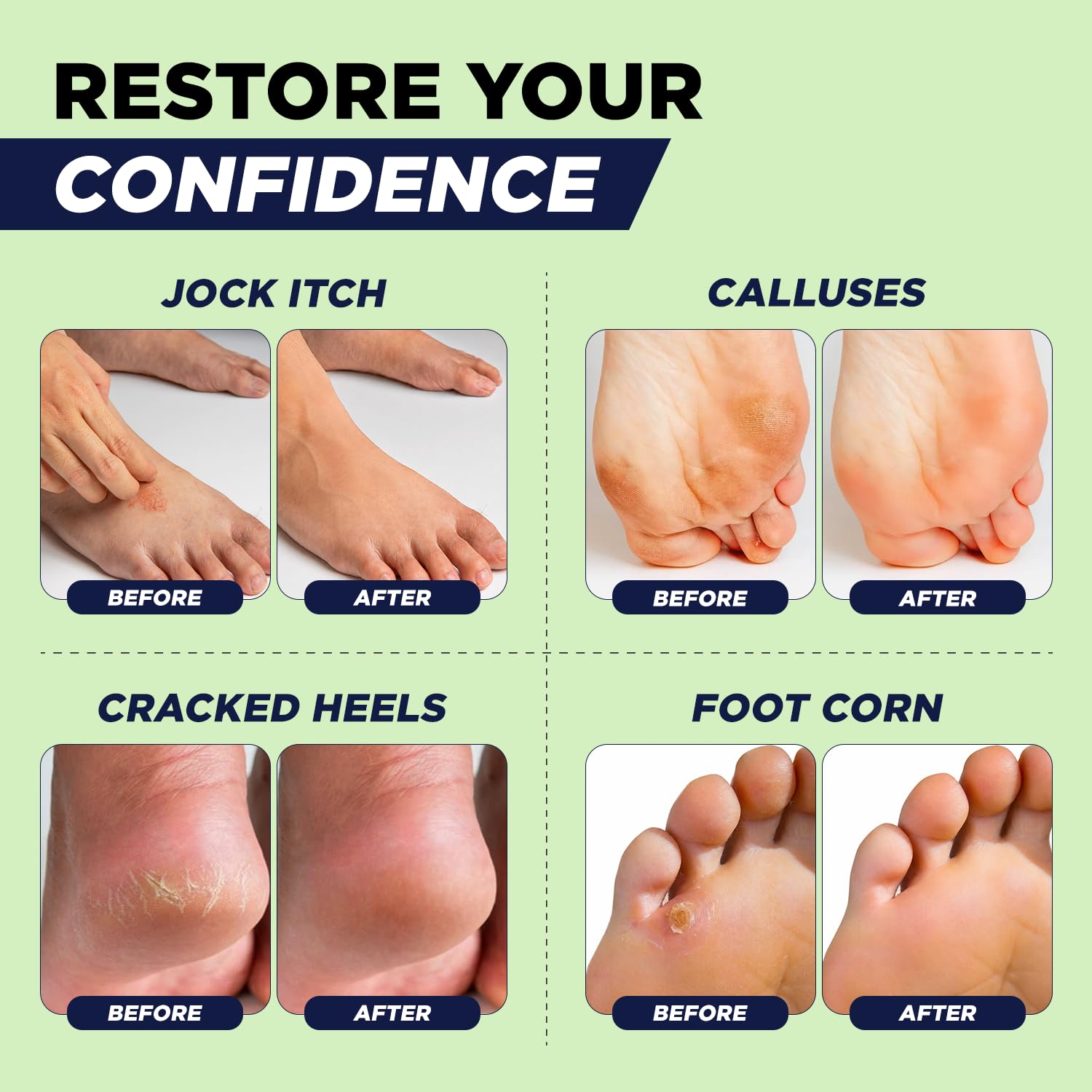 FOOT CURE Tea Tree Oil Foot Balm for Dry Cracked Heels