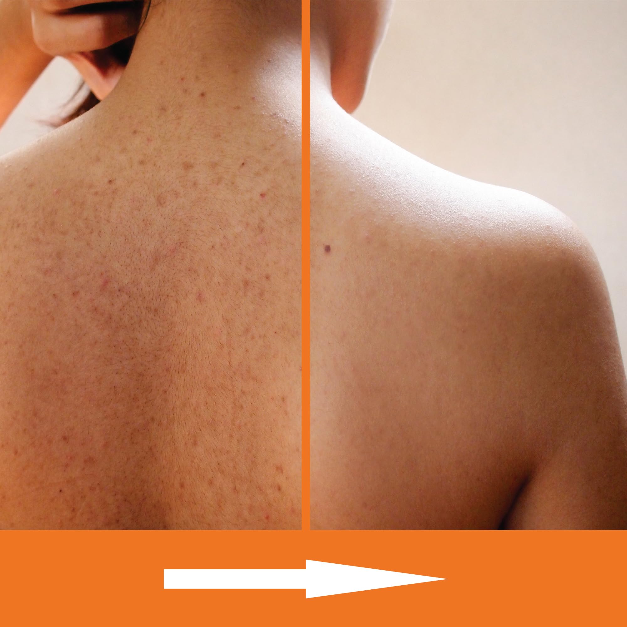 KERAPIL Exfoliating Body Wash with Salicylic Acid Unscented - KERAPIL Official Imagery - 4