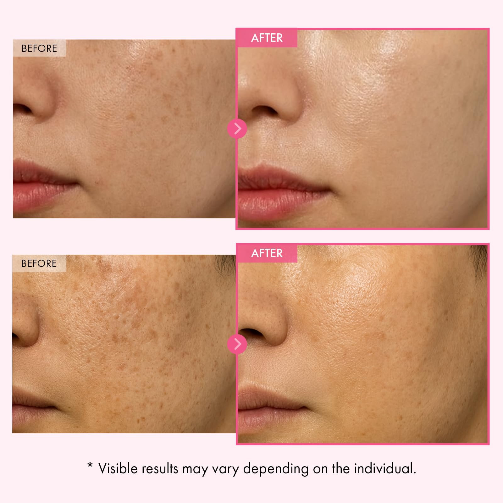 TOSOWOONG Arbutin 7 Glutathione Cream for Dark Spots Uneven - TOSOWOONG Official Product Imagery - 5