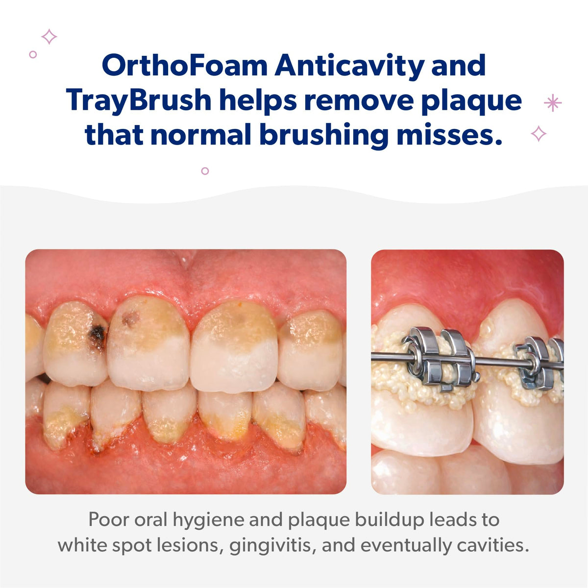 EverSmile Braces Care Bundle for Kids OrthoFoam Anticavity - EverSmile Official Imagery - 4
