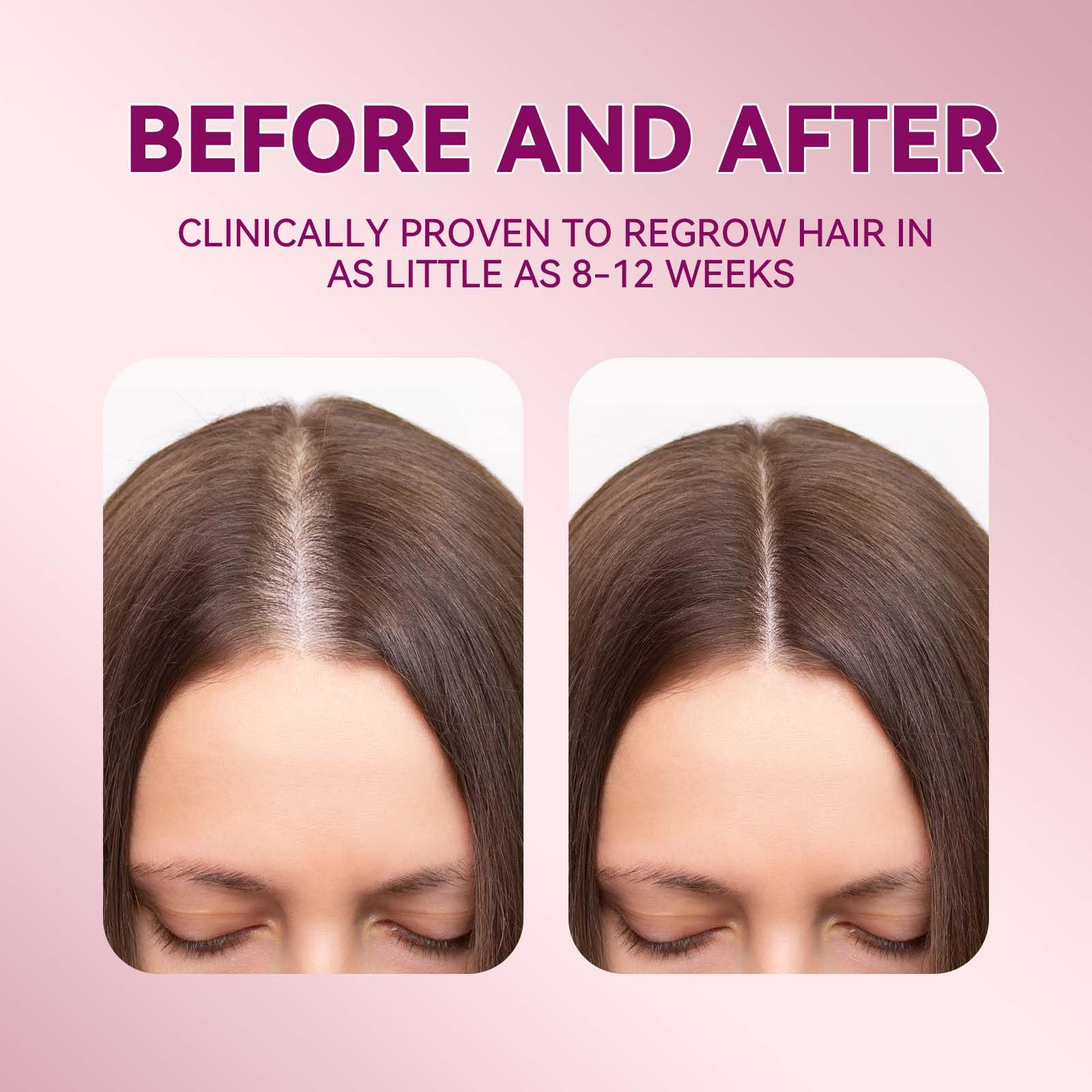 Lavtek 5% Minoxidil Hair Growth Women, Minoxidil Hair Growth Serum with Biotin - Lavtek Official Product View 5