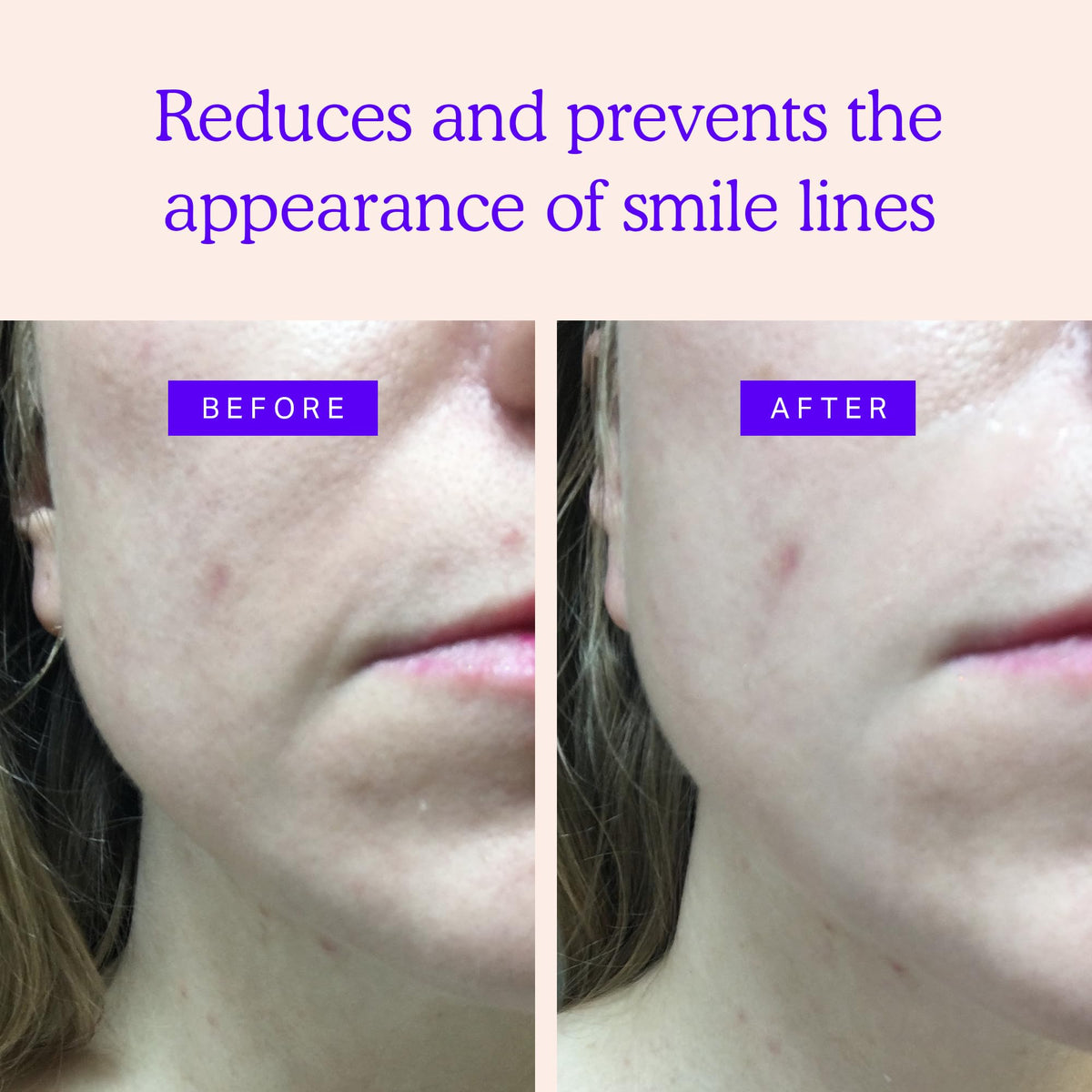 Face Wrinkle Patches - BLUMBODY Official Imagery - 6