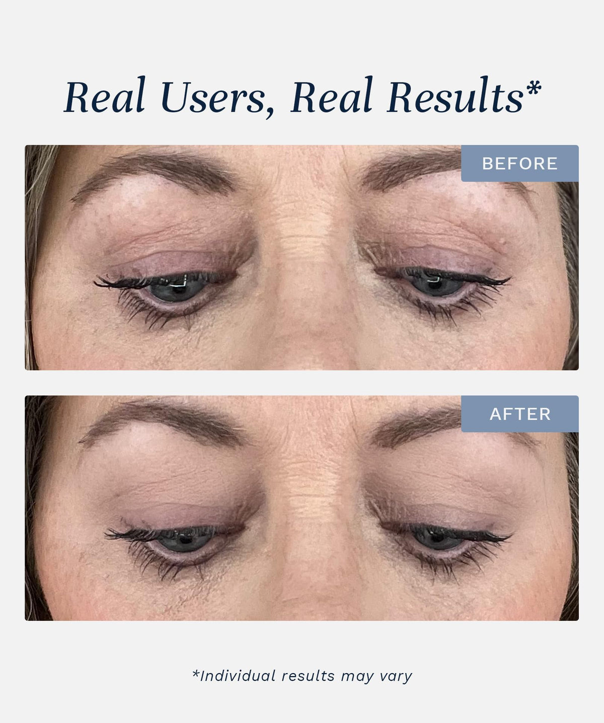 City Beauty Lid Lifting Treatment - City Beauty Official Imagery - 4