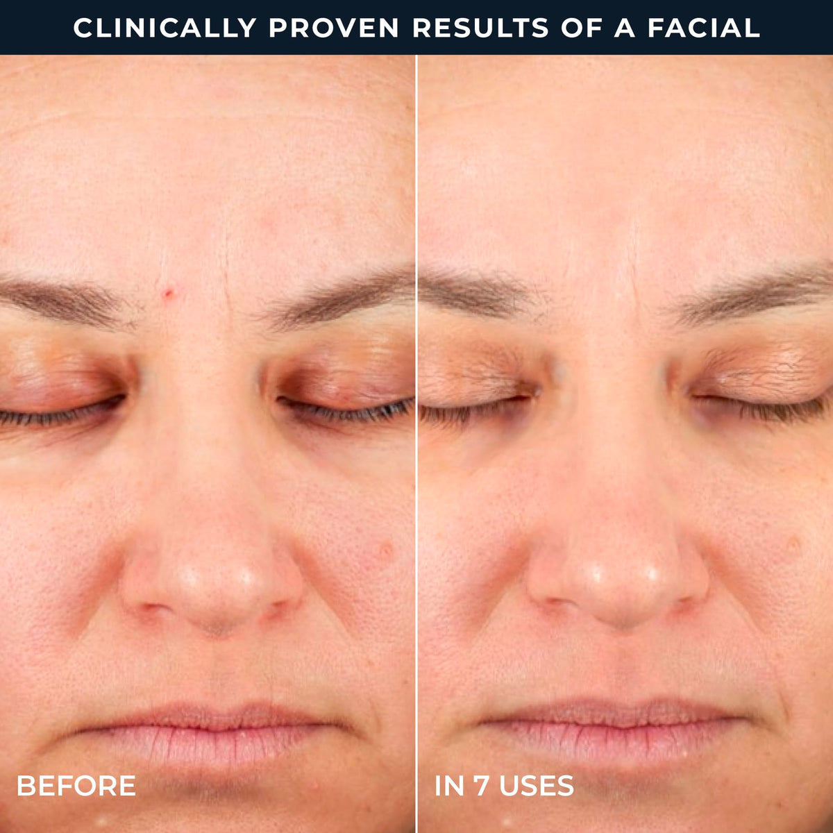 RoC Retinol Correxion 2-step facial peel pads for smoothing fine lines and improving skin texture.