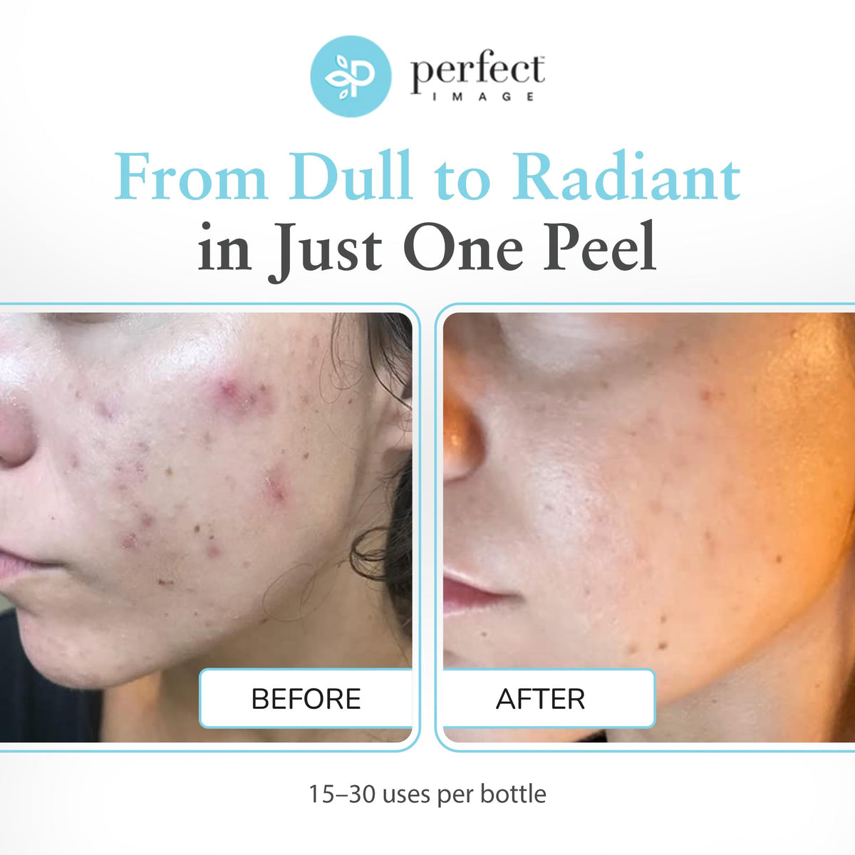 Glycolic Acid 30 Gel Peel - Perfect Image Official Imagery - 4
