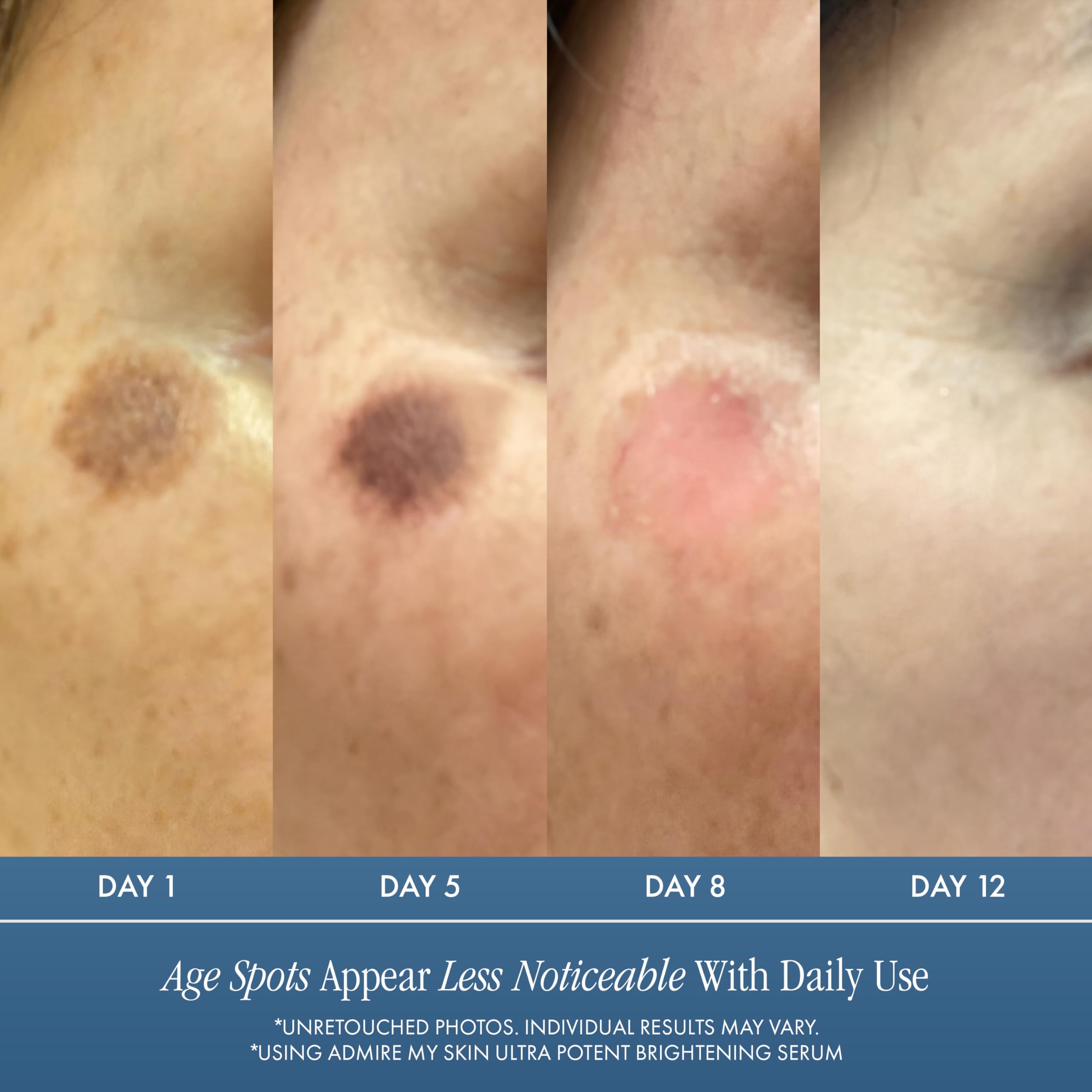 Admire My Skin Dark Spot Corrector Remover for Face Brightening Serum - Admire My Skin Official Product View 4