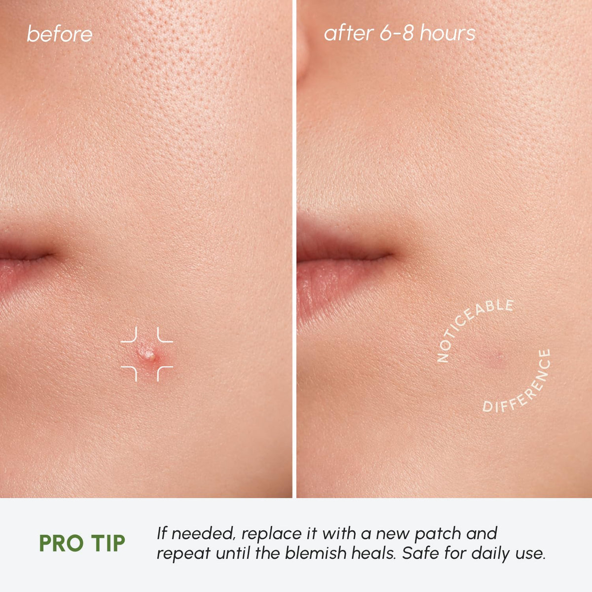 MAREE Invisible Pimple Patches 2Pk - MAREE Official Imagery - 8