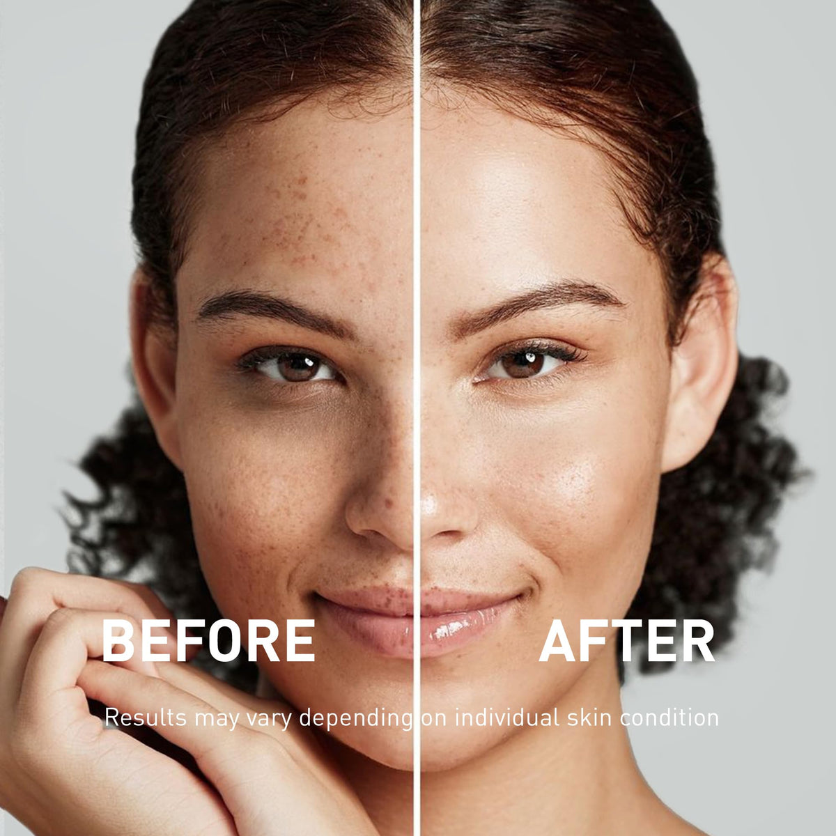 Abera Melasma Serum Plus Dark Spot Corrector Niacinamide 1 - ABERA Official Imagery - 4