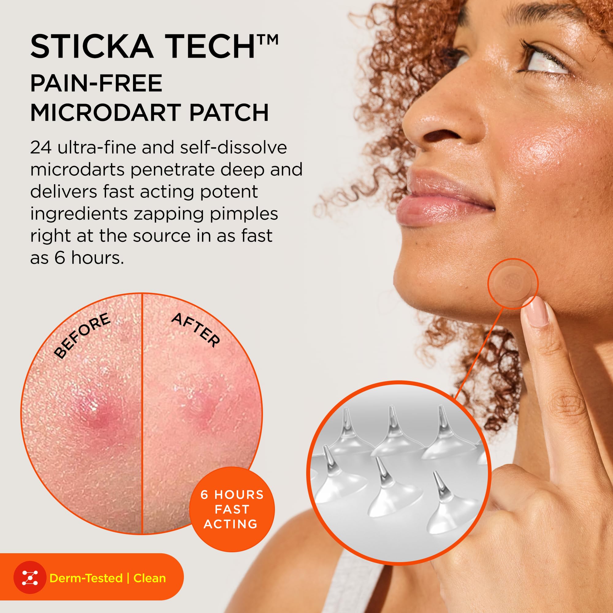 ZitSticka Killa Kit Microdart Pimple Patch For Face, - ZitSticka
