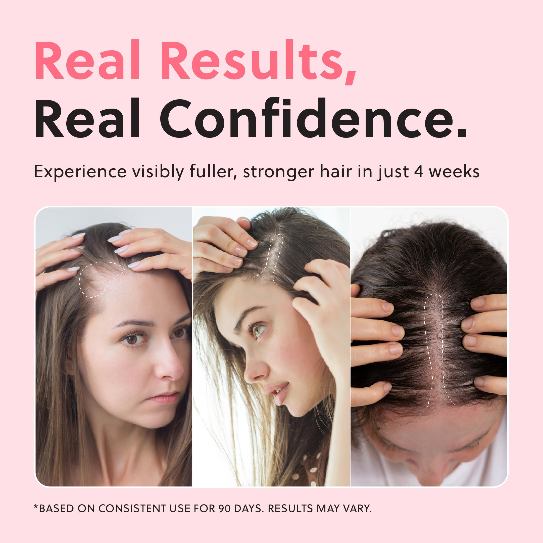 ForChics Hair Growth Spray - Hormone Free Safe Hair Regrowth - Forchics Official Product View 4