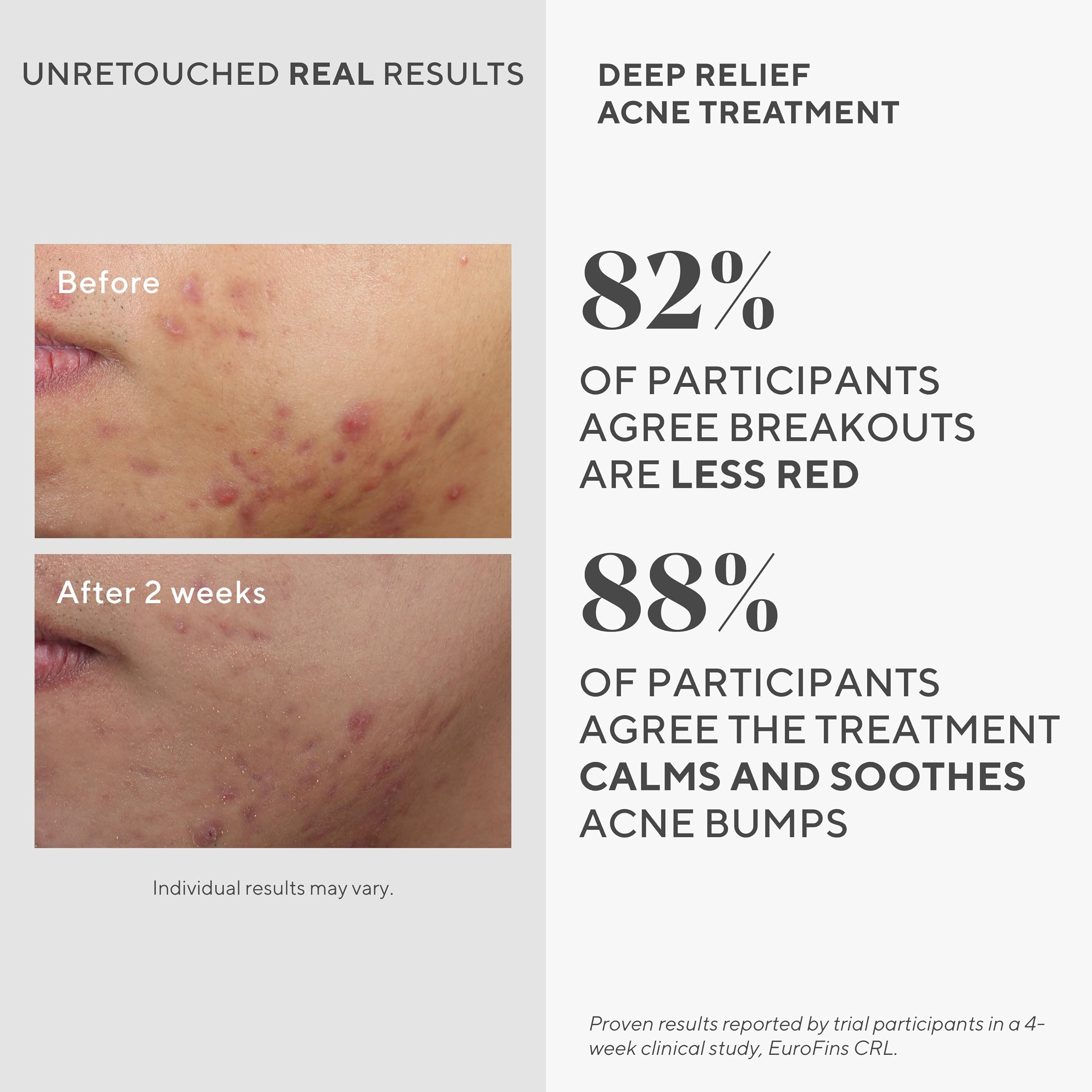 Murad Acne SOS Dual Treatment Combo - Generic