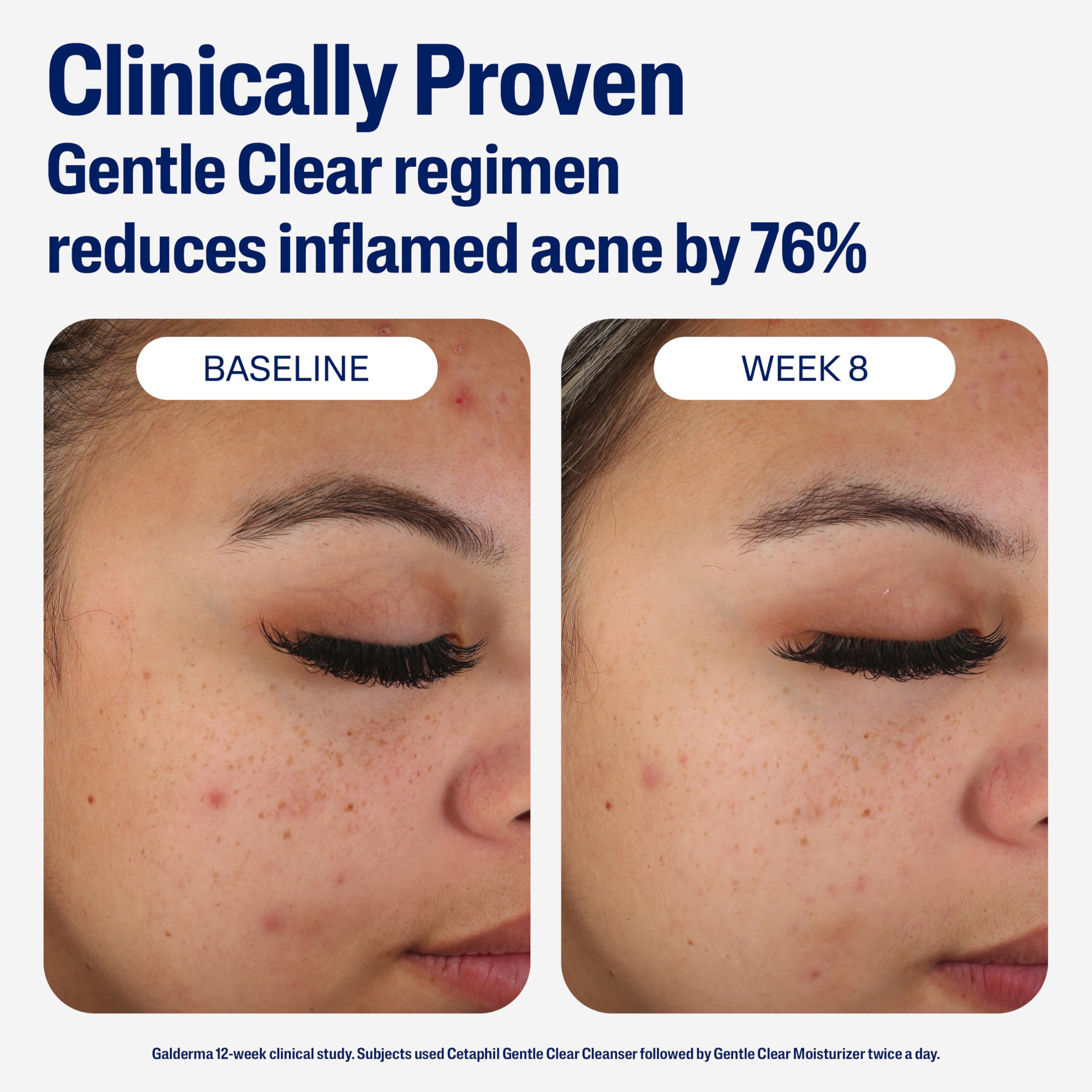 Cetaphil Gentle Clear Mattifying Acne Face Moisturizer, - Cetaphil