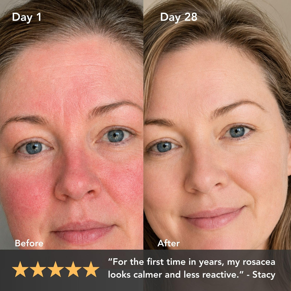 Redness Calming Cream for Rosacea Sensitive Skin - Riversol Official Imagery - 4