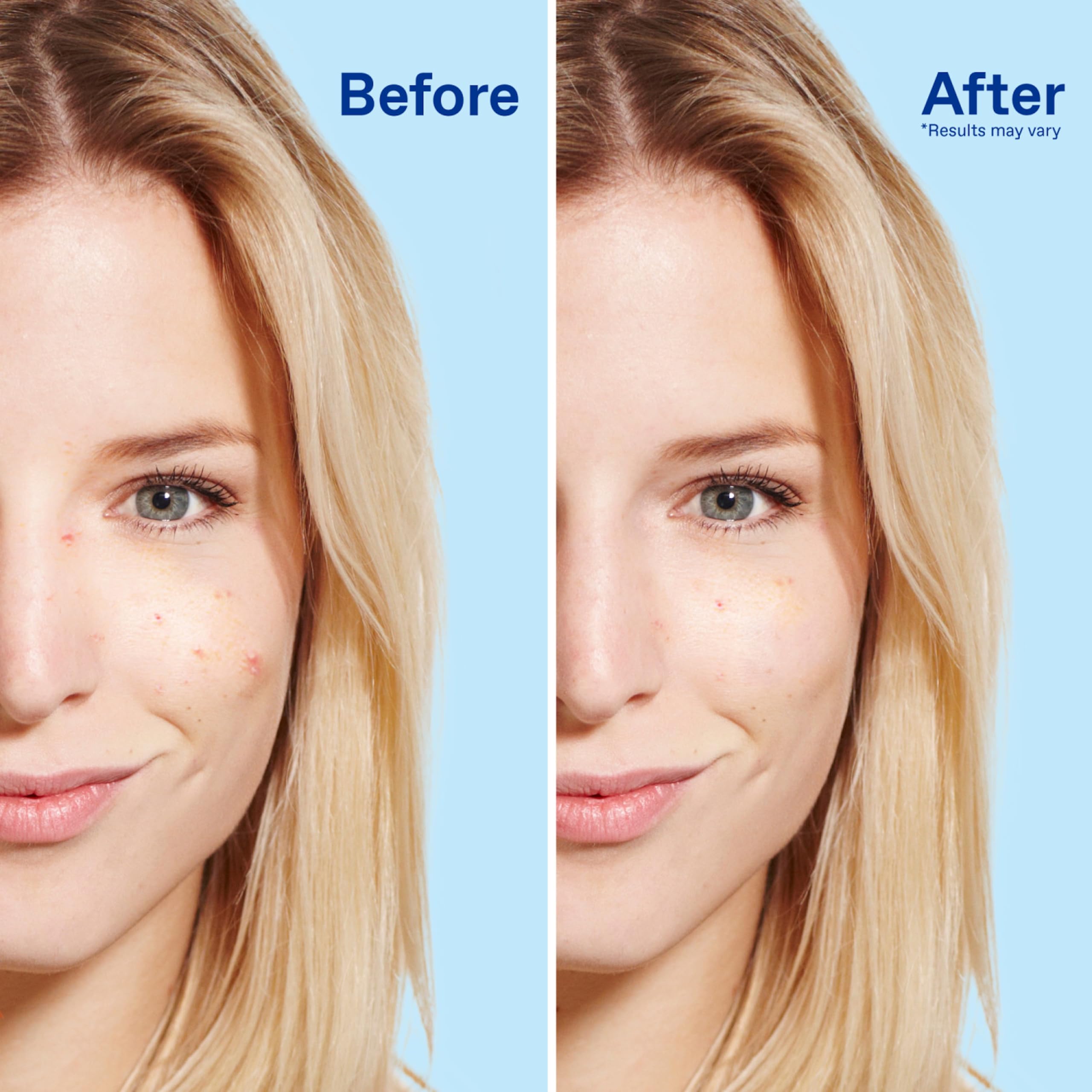 Differin Acne Face Wash, 5% Benzoyl Peroxide Daily Cleanser - Differin Official Product View 6