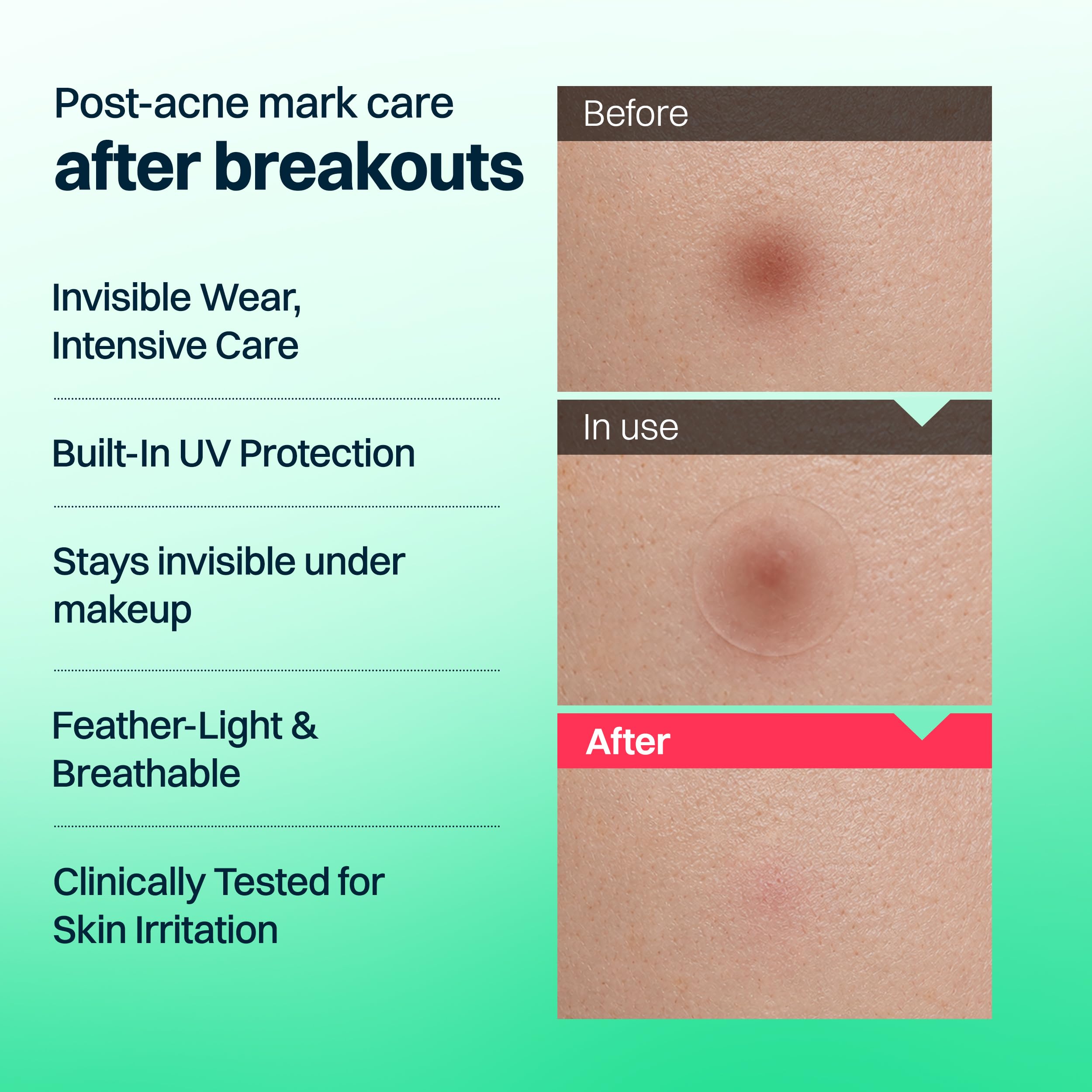 FRANZ Invisible Post Acne Mark Patches Tone Care Dots - FRANZ Official Product Imagery - 4