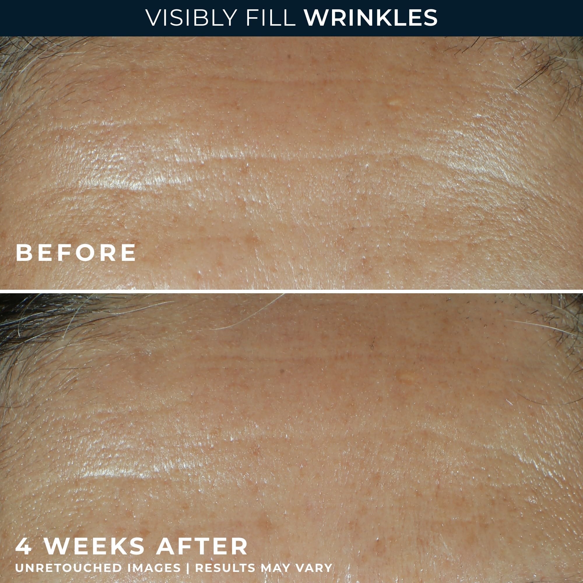 RoC Retinol Correxion Wrinkle Filler for Deep Wrinkles with - RoC Official Imagery - 5