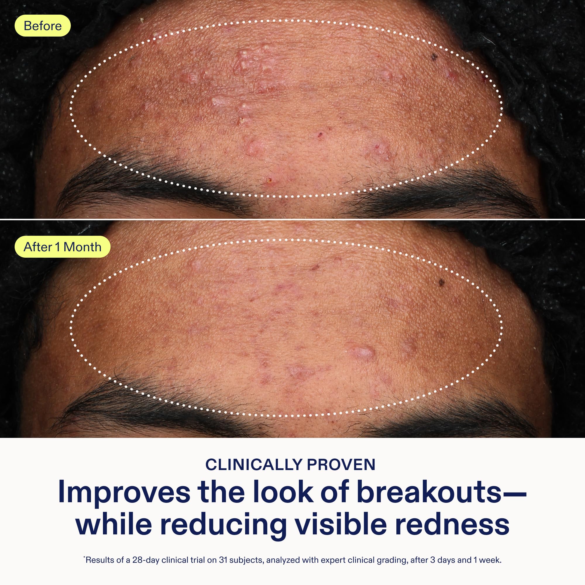 Skinfix Adapinoid Gel - Skinfix Official Imagery - 4