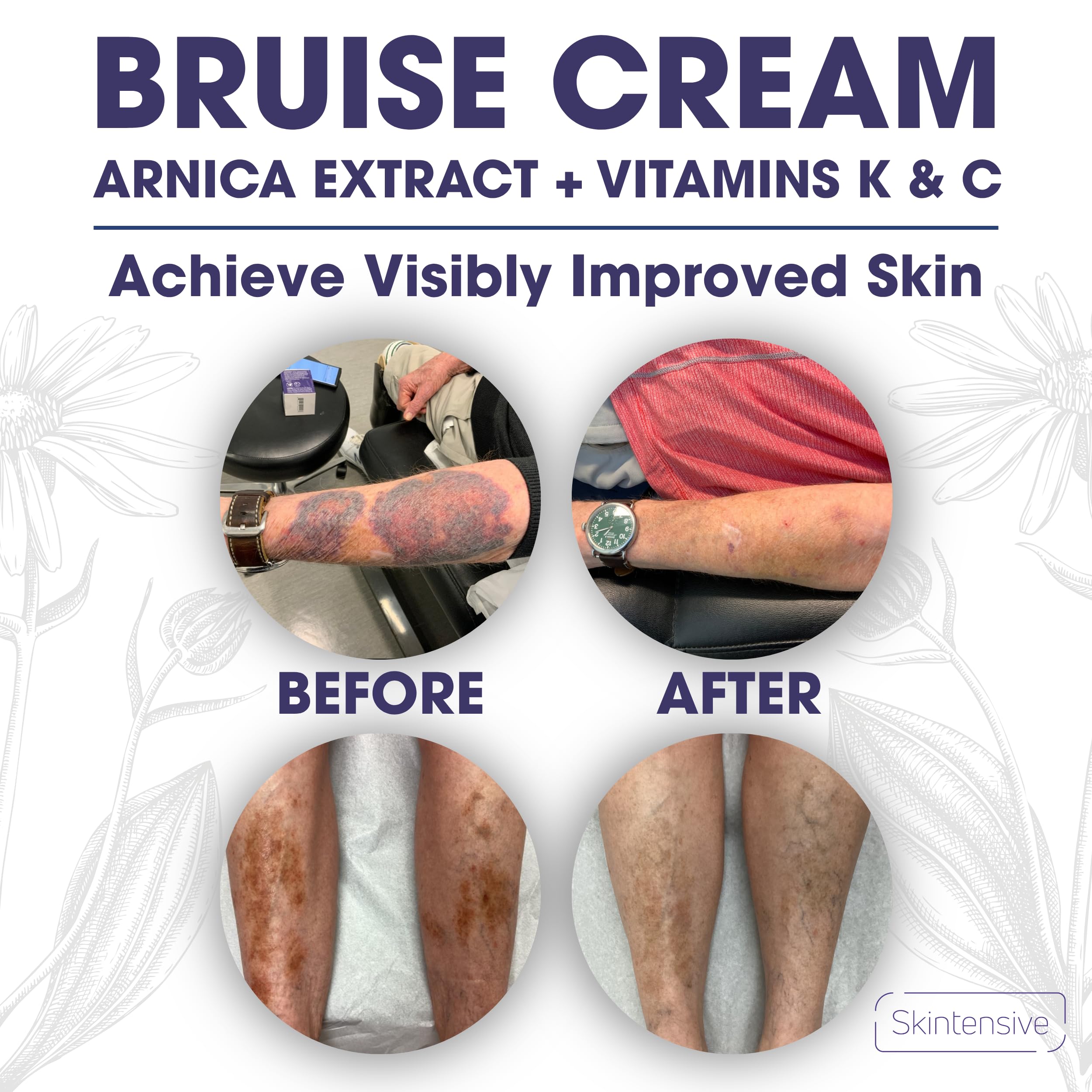 SKINTENSIVE Arnica Bruise Cream for Thin Skin Vitamin K - SKINTENSIVE Official Product Imagery - 6