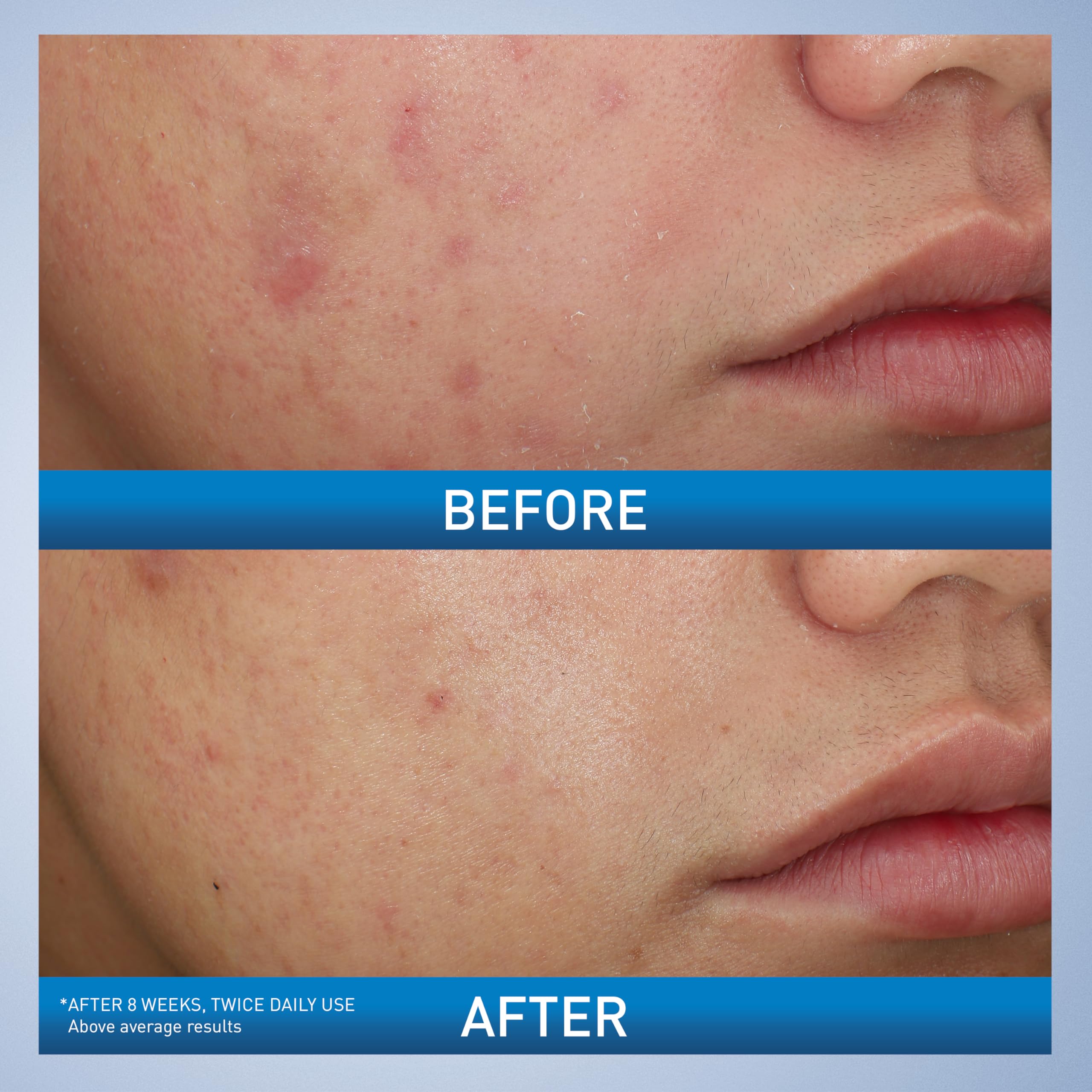 CeraVe Acne Foaming Cream Wash, 10% Benzoyl Peroxide Facial Cleanser - CeraVe Official Product View 4