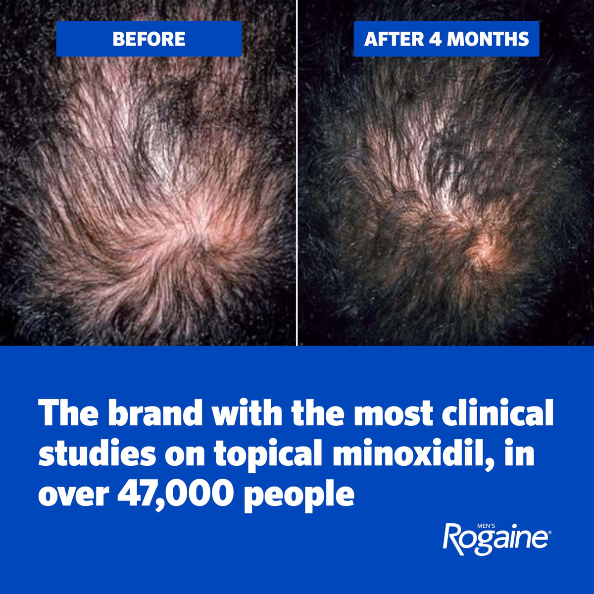 Men s Rogaine 5 Minoxidil Topical Foam Unscented 3 Mo Supply - Rogaine Official Imagery - 5