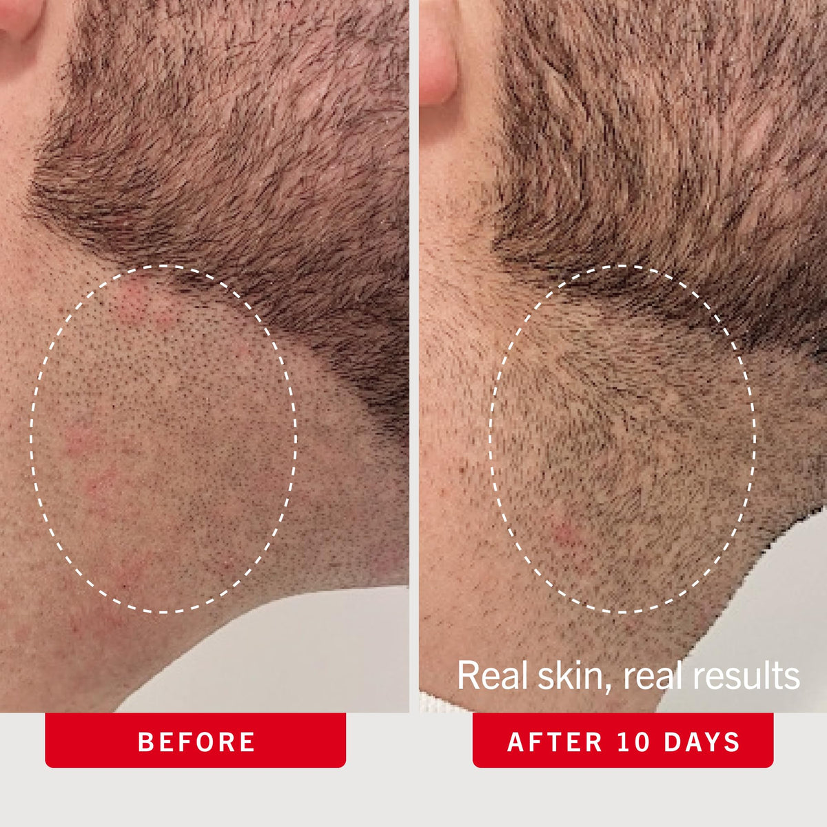 First Aid Beauty Ingrown Hair Pads with BHA and AHA - Premium Selection Official Imagery - 6