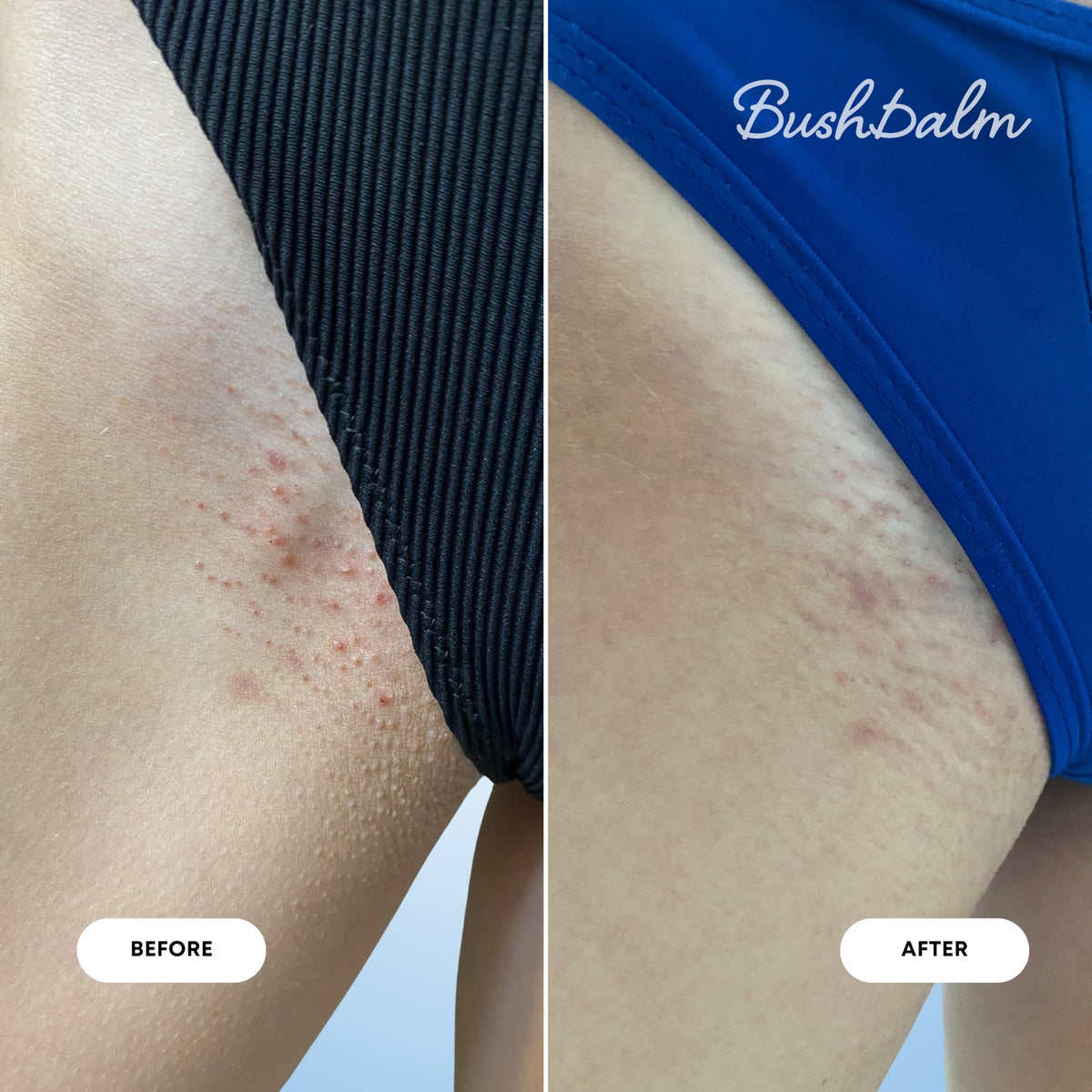 Bushbalm 2 Step Ingrown Hair Routine - Bushbalm Official Imagery - 8