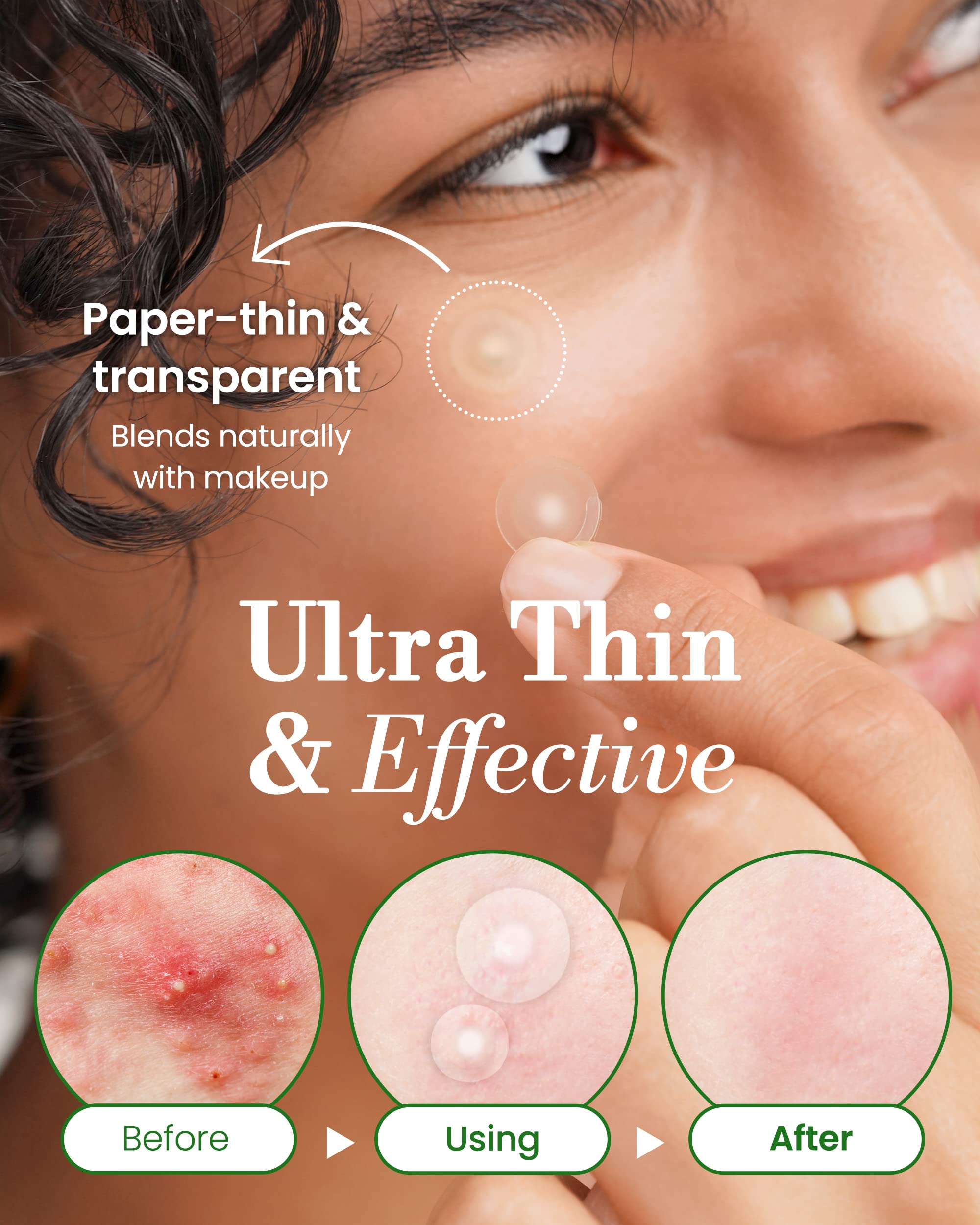 Invisible Pimple Spot Patch - Classic, Hydrocolloid Acne Patches for Face | Ultra Thin Acne Patches with Easy Peel Handle | Overnight Pimple Patches | 2 Sizes, 96 Count (Pack of 1) - Troubless Official Product View 6