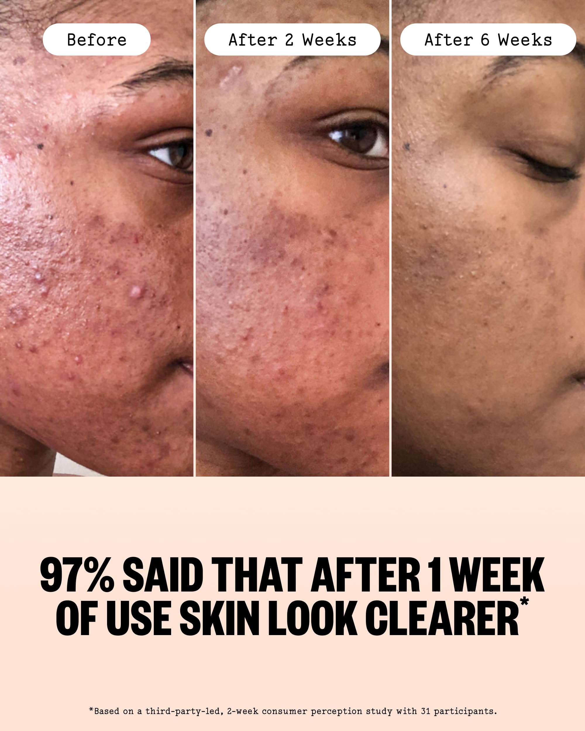 PEACE OUT Acne Face Serum with 2% Salicylic Acid - PEACE OUT Official Product View 5
