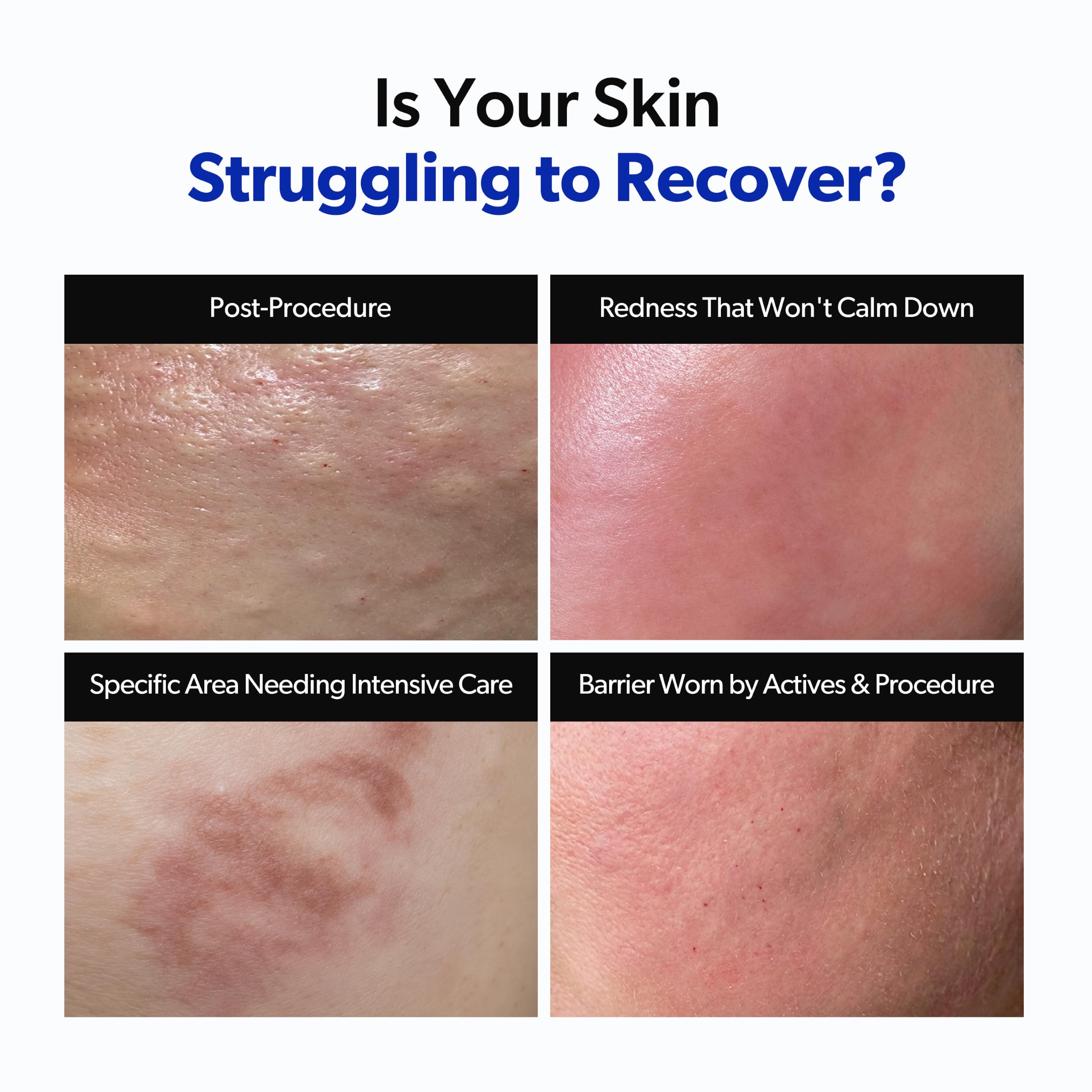 Dermafactor 30% Growth Factor Intensive Recovery Spot Care - bnv biolab