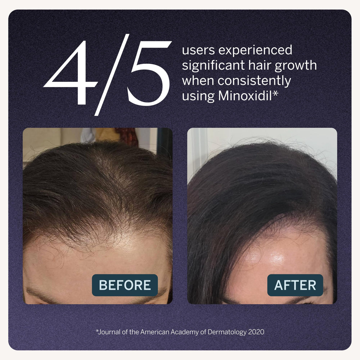 Minoxidil Topical Hair Serum 2 Solution for Women - Happy Head Official Imagery - 3