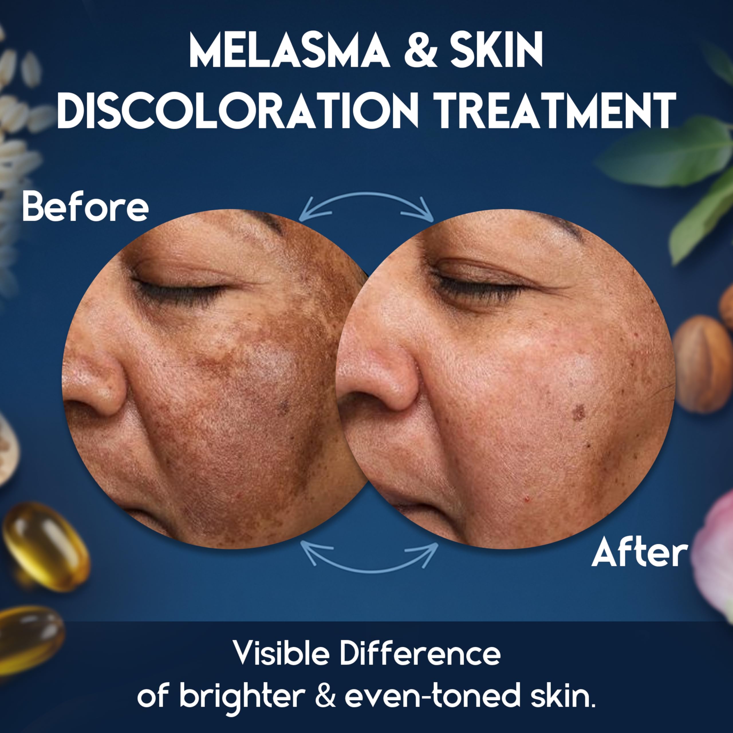 Pharmlitalia Melasma Cream – Dark Spot Remover Face & Body